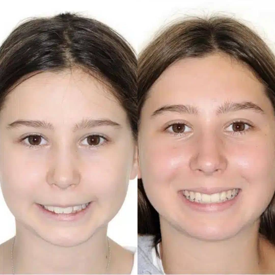 Before and after overbite correction in Manhattan showing a teen patient’s improved smile and facial balance