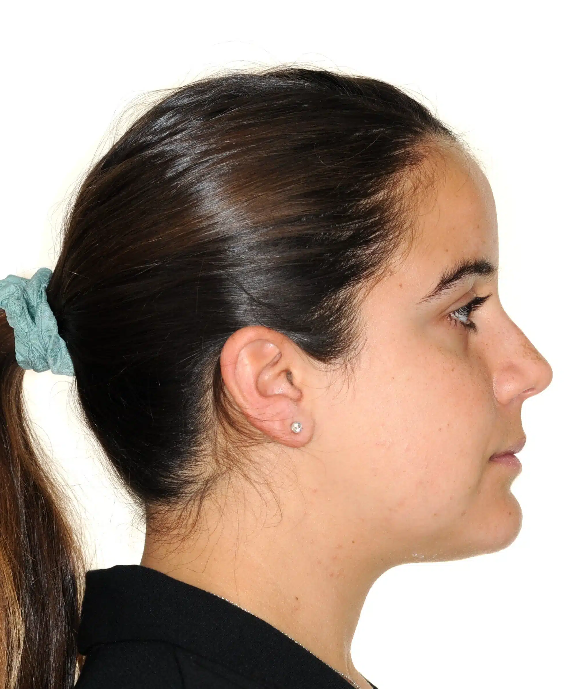 130950 - 9-22-2018 progress relapse going into treatment with INvisalign - 130950 - Ines Castro - Progress 39 - Facial Profile.jpg
