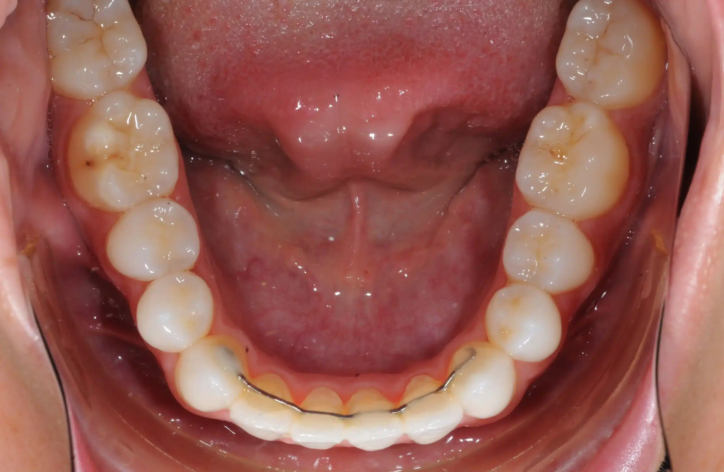 130950 - 9-22-2018 progress relapse going into treatment with INvisalign - 130950 - Ines Castro - Progress 39 - Occlusal Lower.jpg