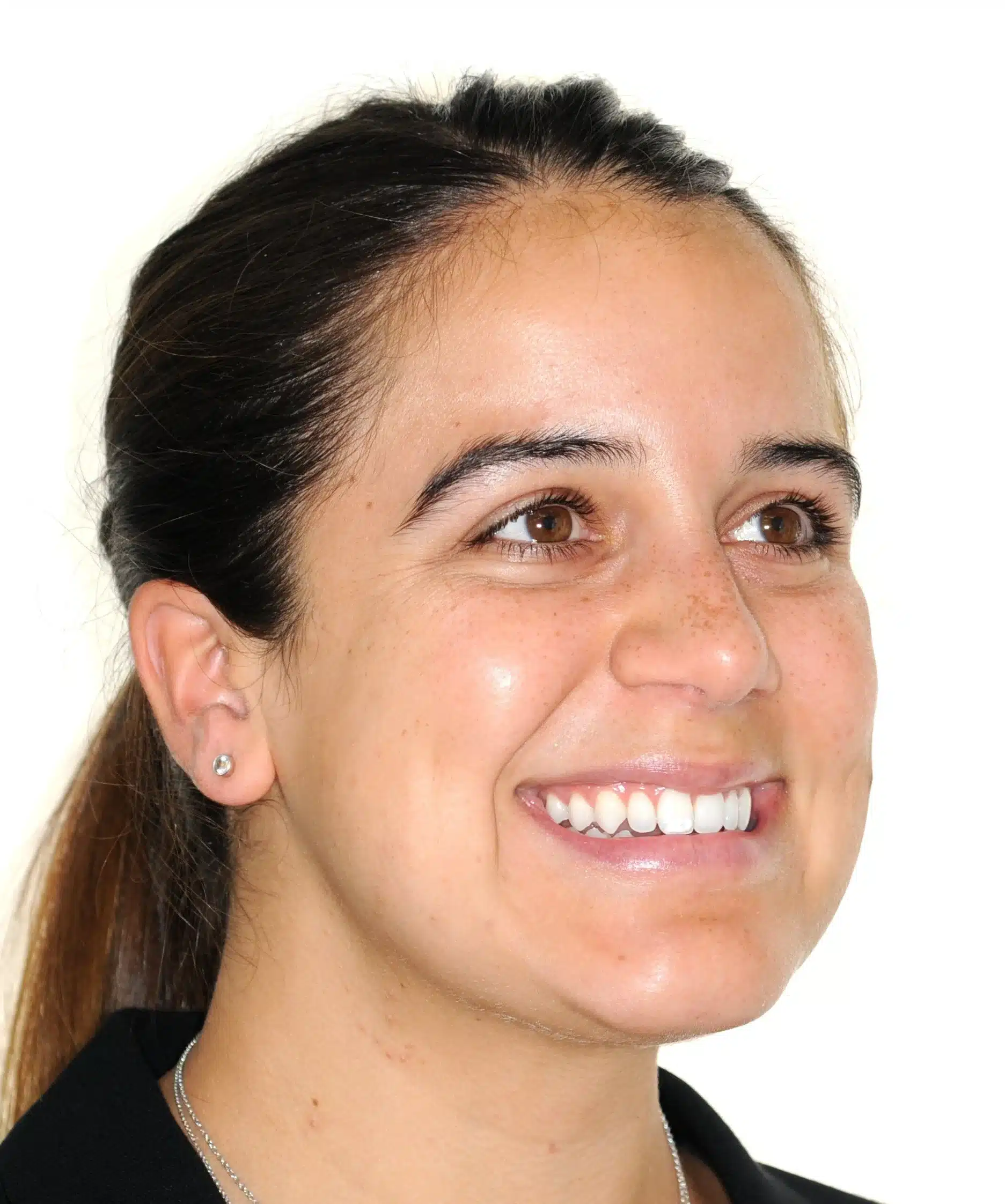 130950 - 9-22-2018 progress relapse going into treatment with INvisalign - 130950 - Ines Castro - Progress 39 - Facial 34 R.jpg