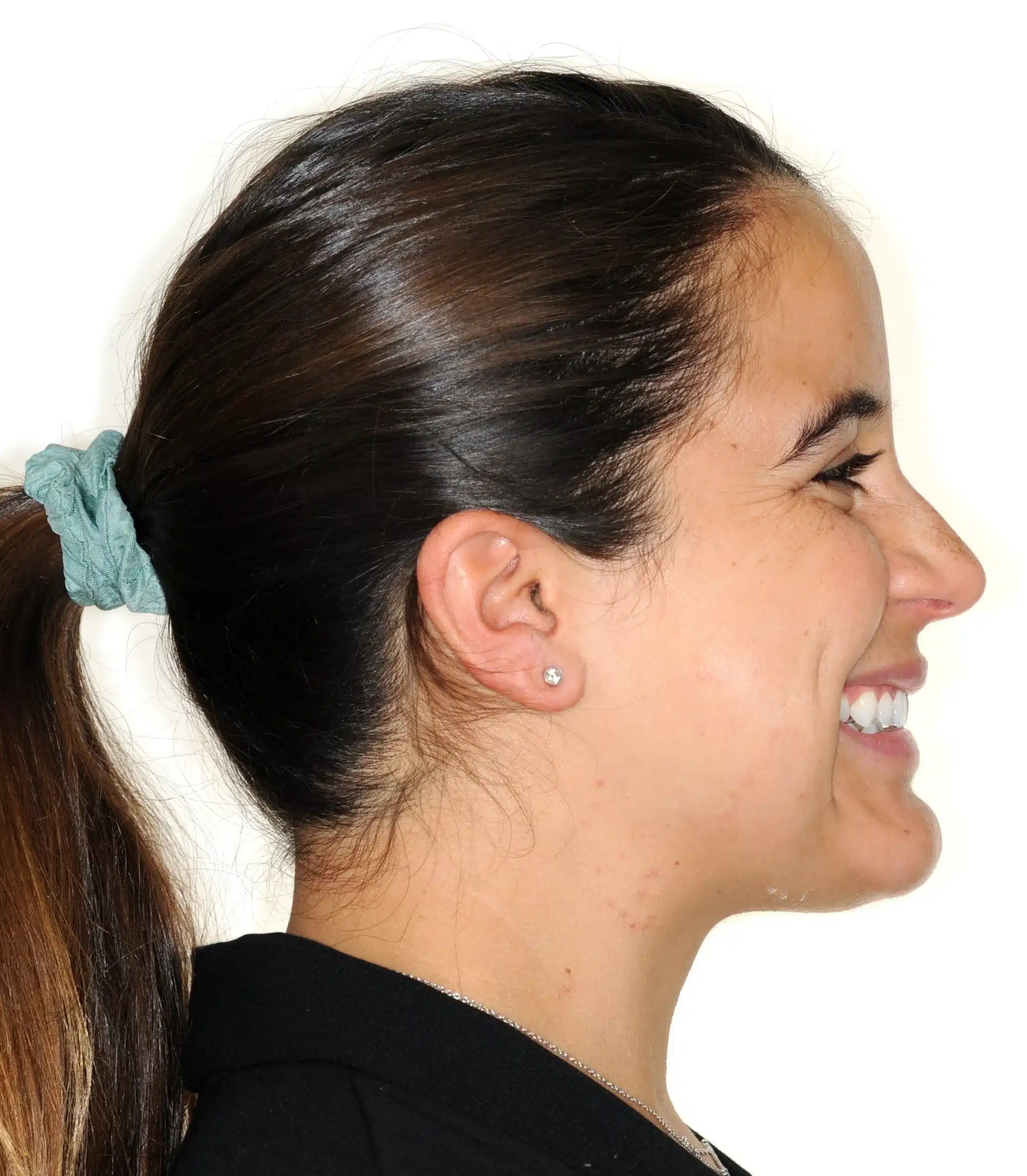 130950 - 9-22-2018 progress relapse going into treatment with INvisalign - 130950 - Ines Castro - Progress 39 - Facial Profile Smiling.jpg