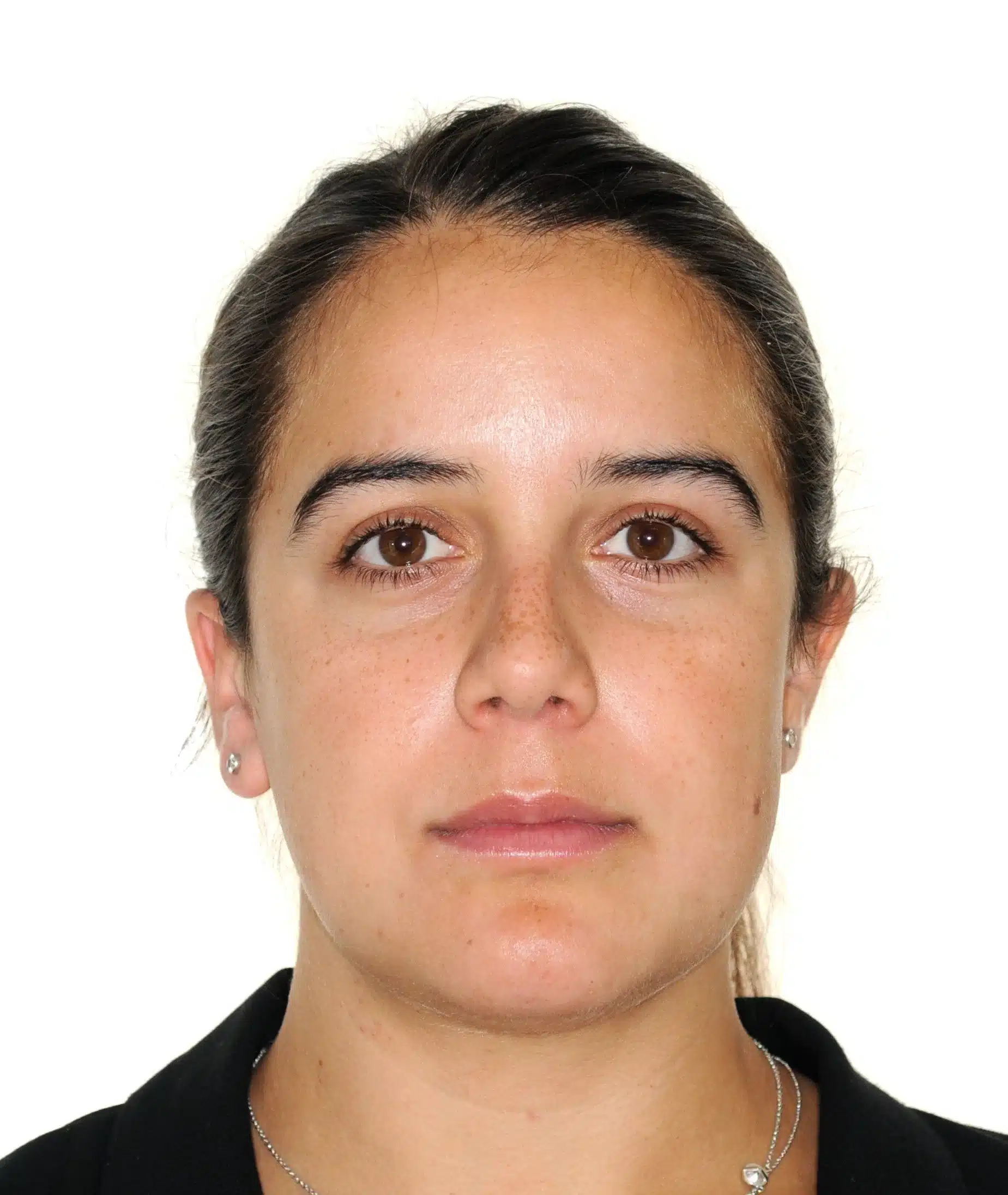 130950 - 9-22-2018 progress relapse going into treatment with INvisalign - 130950 - Ines Castro - Progress 39 - Facial Front.jpg