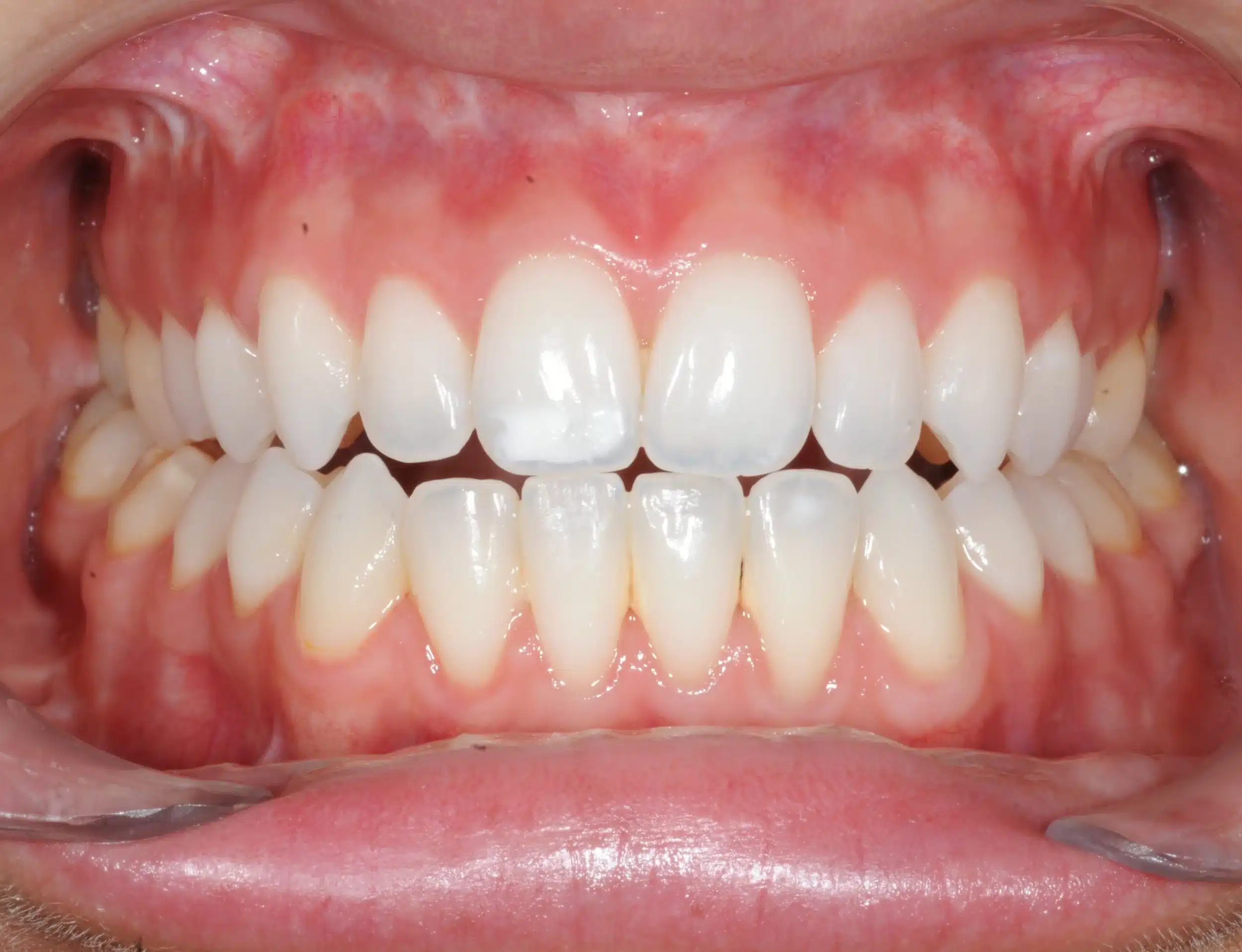 130950 - 9-22-2018 progress relapse going into treatment with INvisalign - 130950 - Ines Castro - Progress 39 - Intraoral Center.jpg