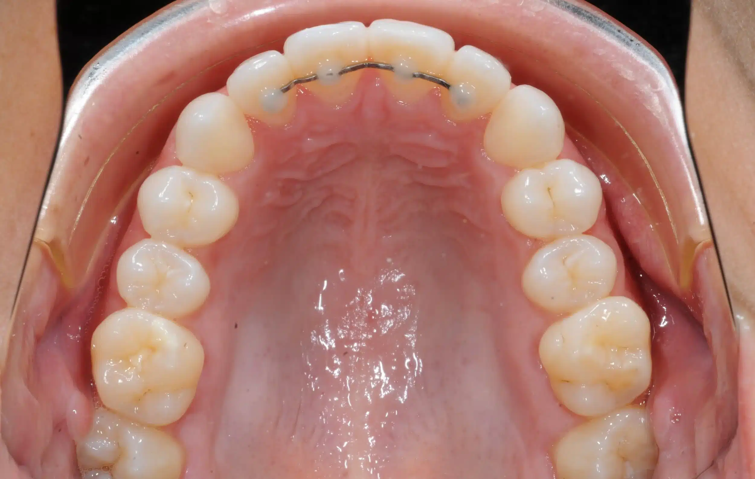 130950 - 9-22-2018 progress relapse going into treatment with INvisalign - 130950 - Ines Castro - Progress 39 - Occlusal Upper.jpg