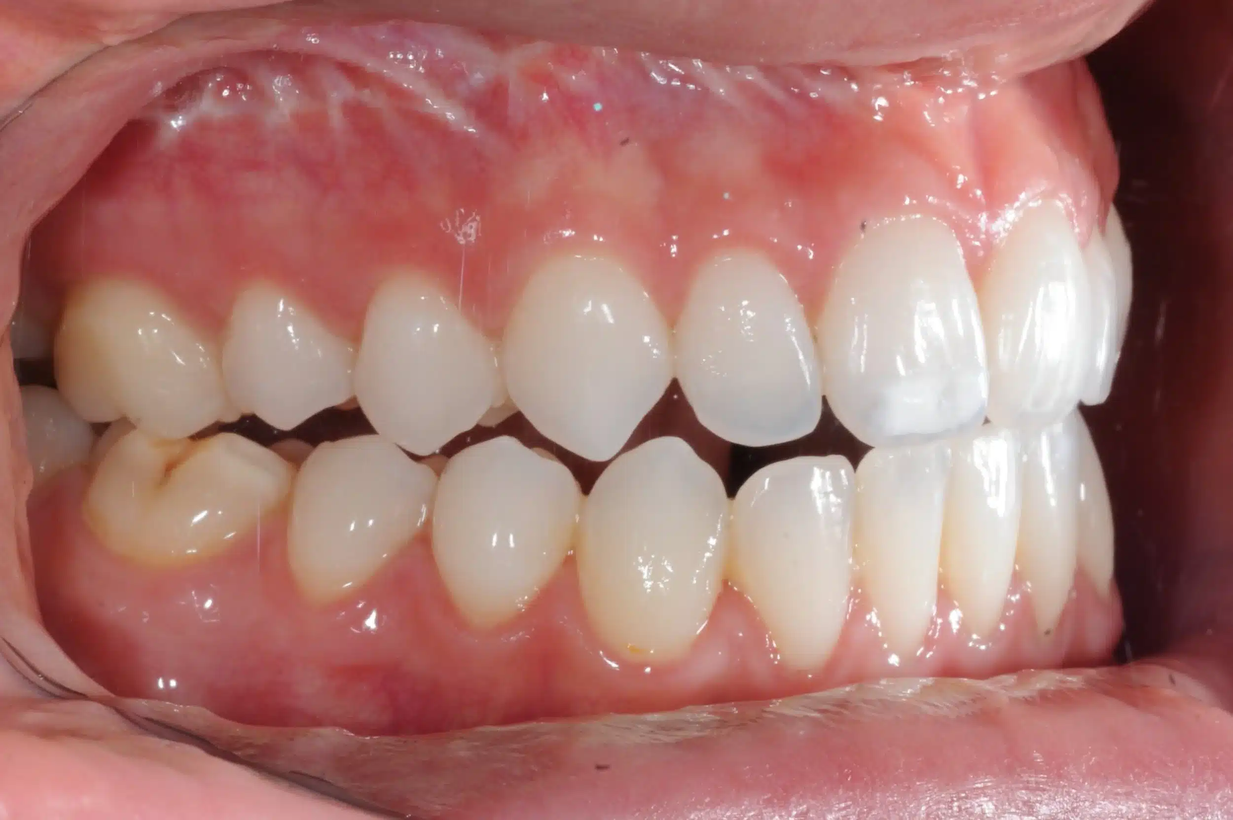 130950 - 9-22-2018 progress relapse going into treatment with INvisalign - 130950 - Ines Castro - Progress 39 - Intraoral Right.jpg