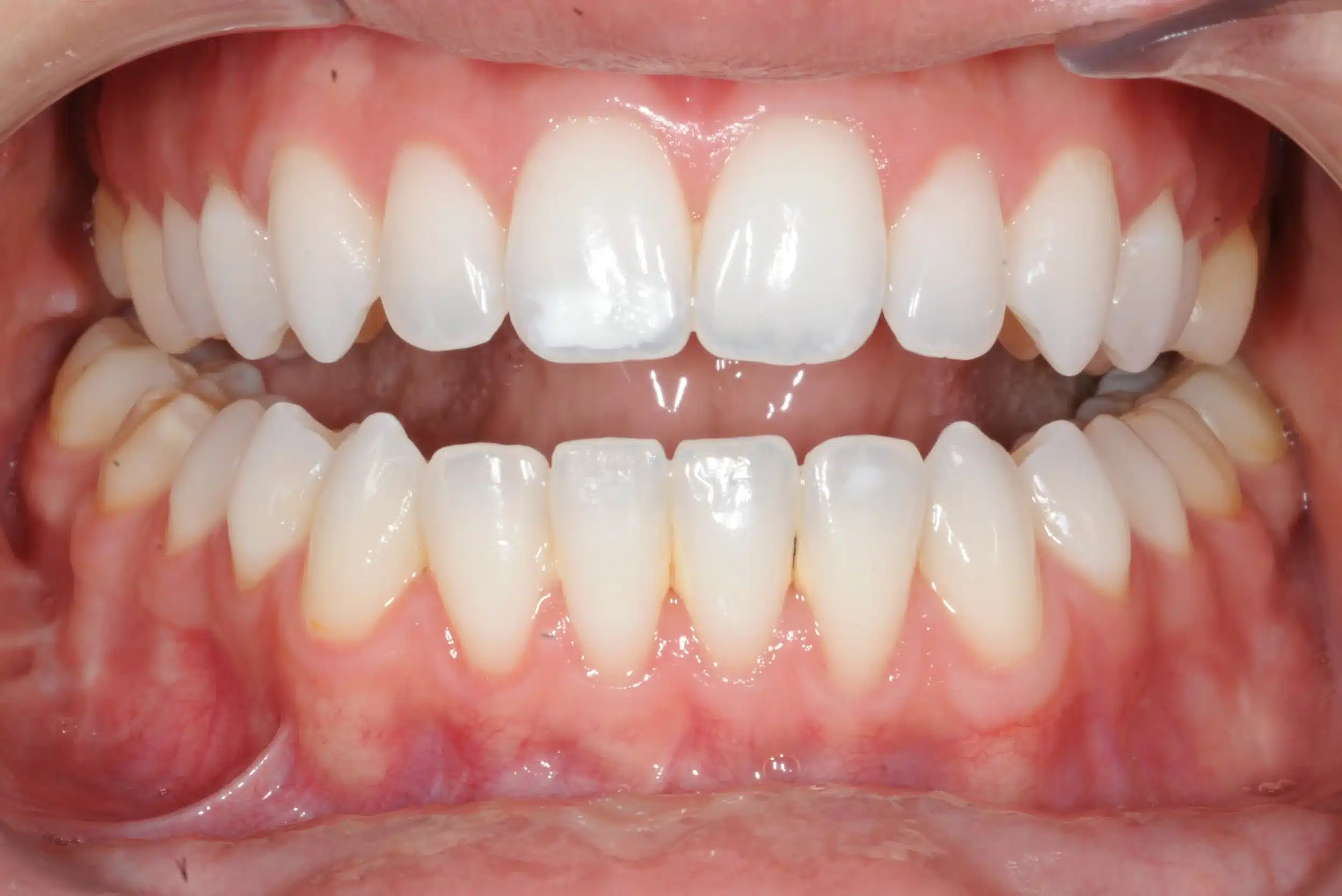 130950 - 9-22-2018 progress relapse going into treatment with INvisalign - 130950 - Ines Castro - Progress 39 - Intraoral Misc.jpg