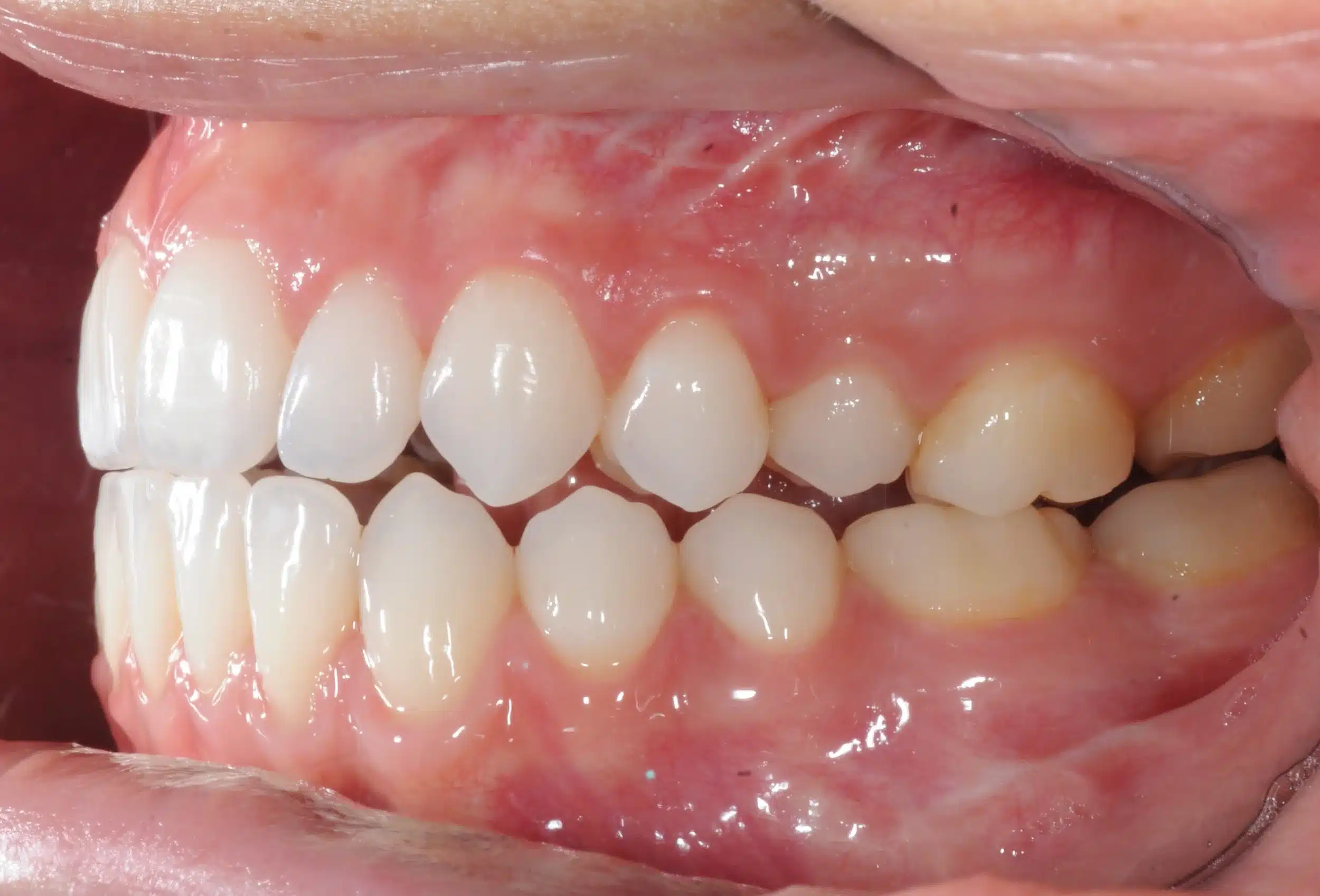 130950 - 9-22-2018 progress relapse going into treatment with INvisalign - 130950 - Ines Castro - Progress 39 - Intraoral Left.jpg