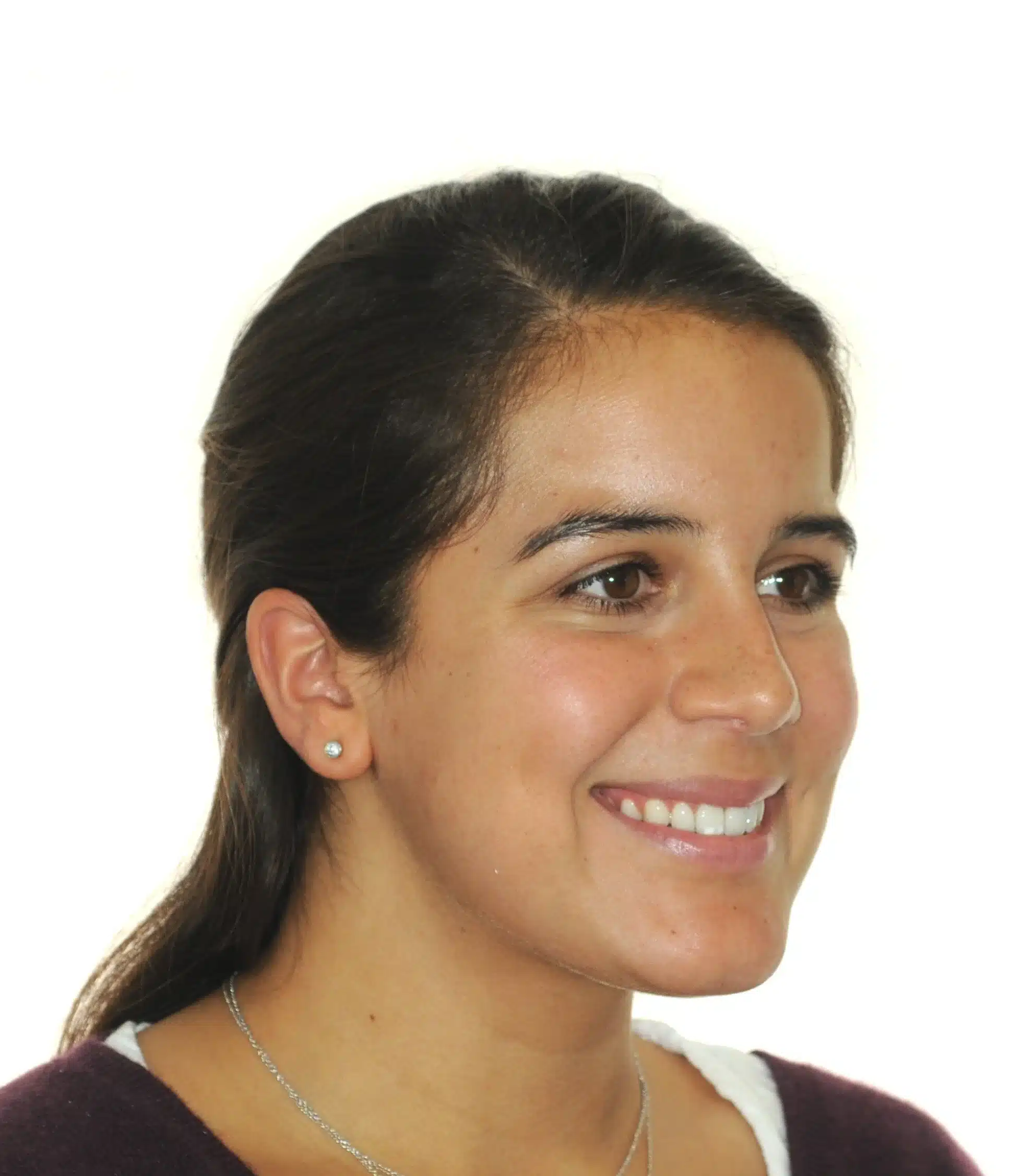 130950- DEBOND 1-12-2025 1ST SET OF BRACES - 130950 - Ines Castro - Deband 11 - Facial 34 R.jpg