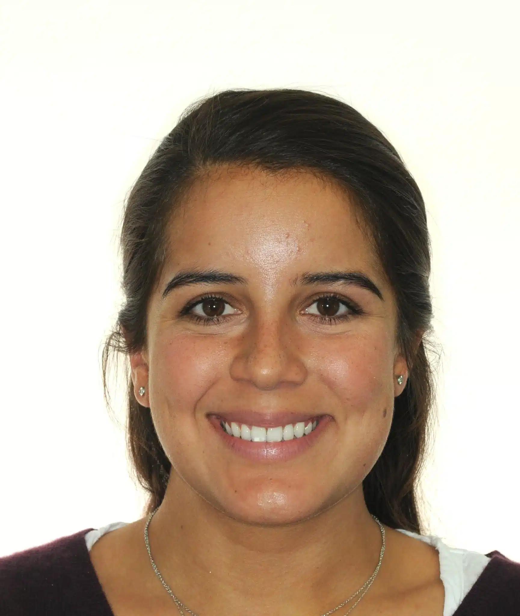 130950- DEBOND 1-12-2025 1ST SET OF BRACES - 130950 - Ines Castro - Deband 11 - Facial Front Smiling.jpg