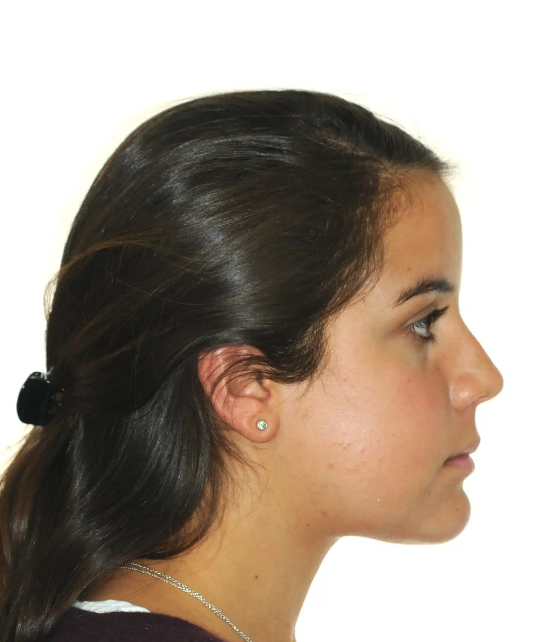 130950- DEBOND 1-12-2025 1ST SET OF BRACES - 130950 - Ines Castro - Deband 11 - Facial Profile.jpg