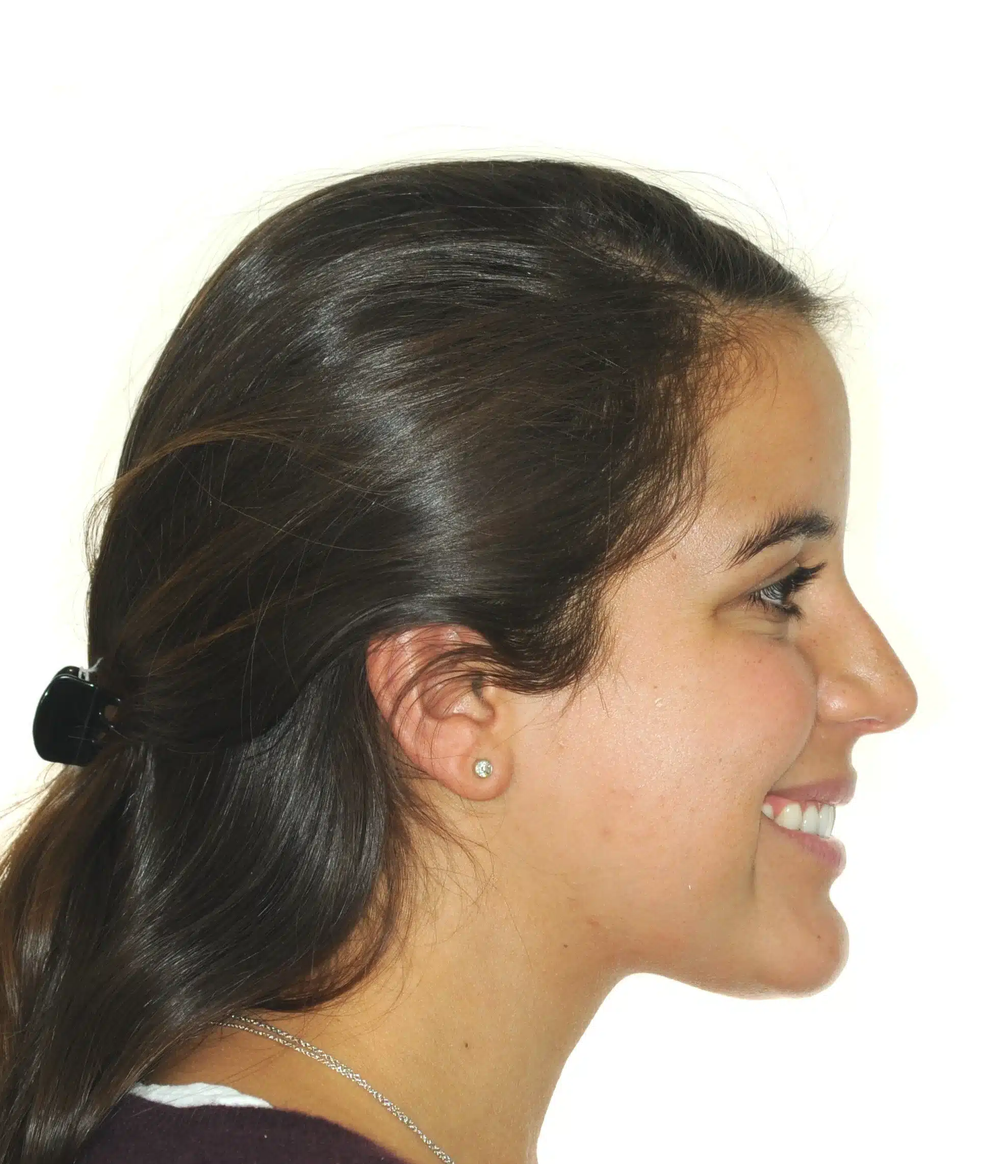 130950- DEBOND 1-12-2025 1ST SET OF BRACES - 130950 - Ines Castro - Deband 11 - Facial Profile Smiling.jpg