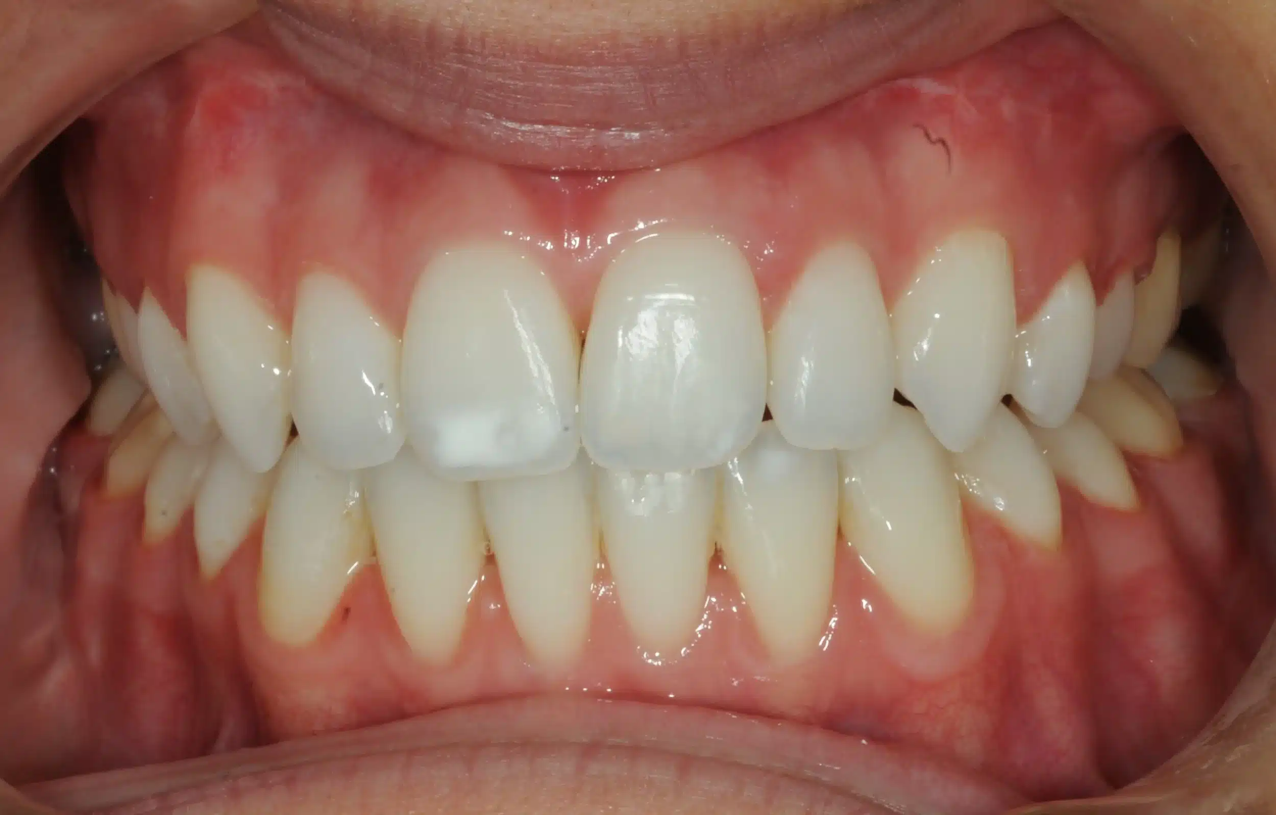 130950- DEBOND 1-12-2025 1ST SET OF BRACES - 130950 - Ines Castro - Deband 11 - Intraoral Center.jpg