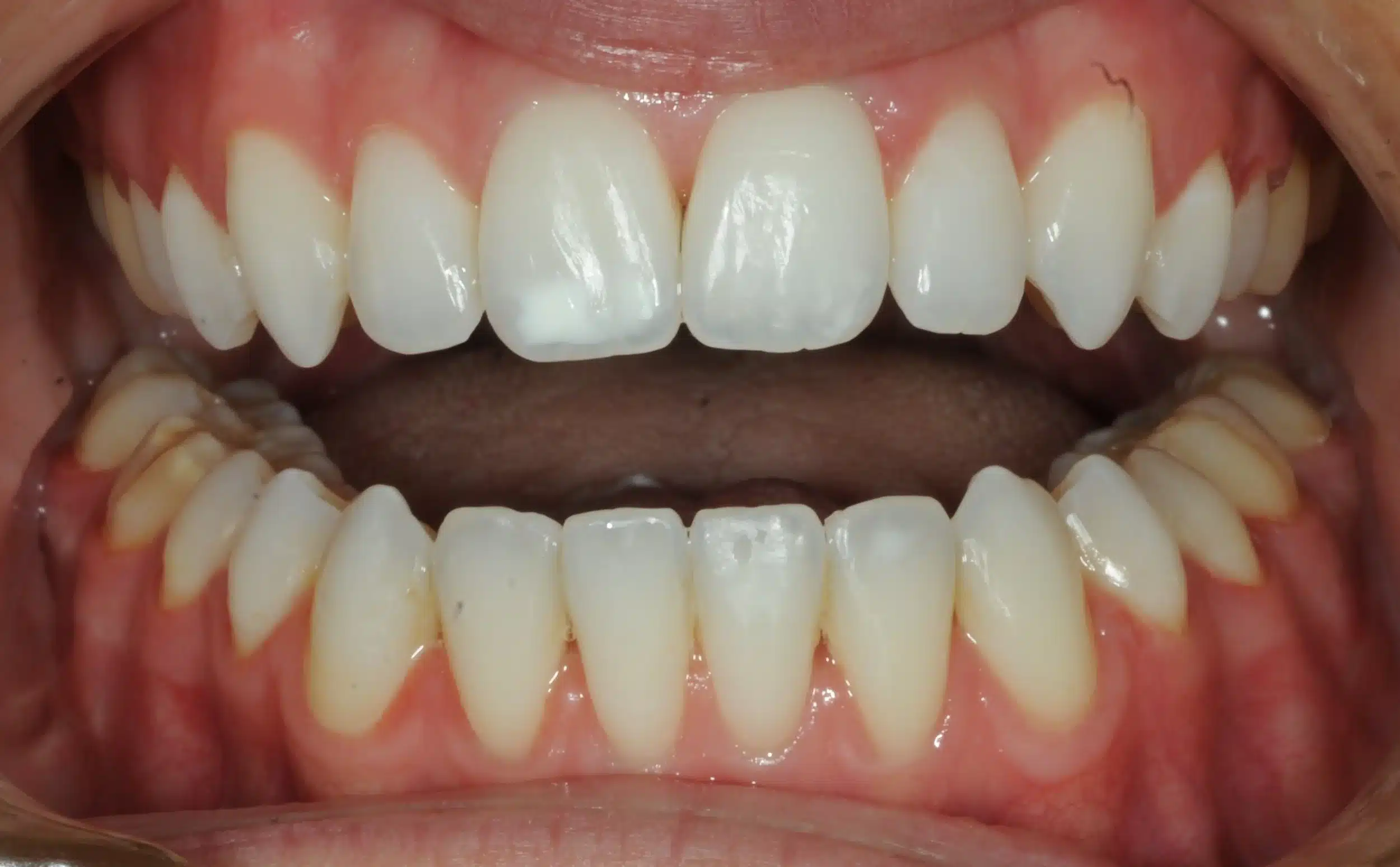 130950- DEBOND 1-12-2025 1ST SET OF BRACES - 130950 - Ines Castro - Deband 11 - Intraoral Misc.jpg