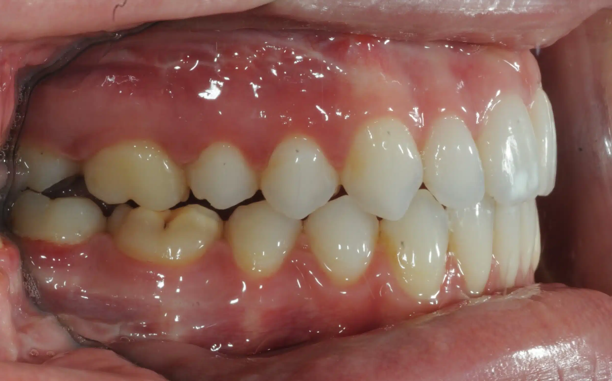 130950- DEBOND 1-12-2025 1ST SET OF BRACES - 130950 - Ines Castro - Deband 11 - Intraoral Right.jpg