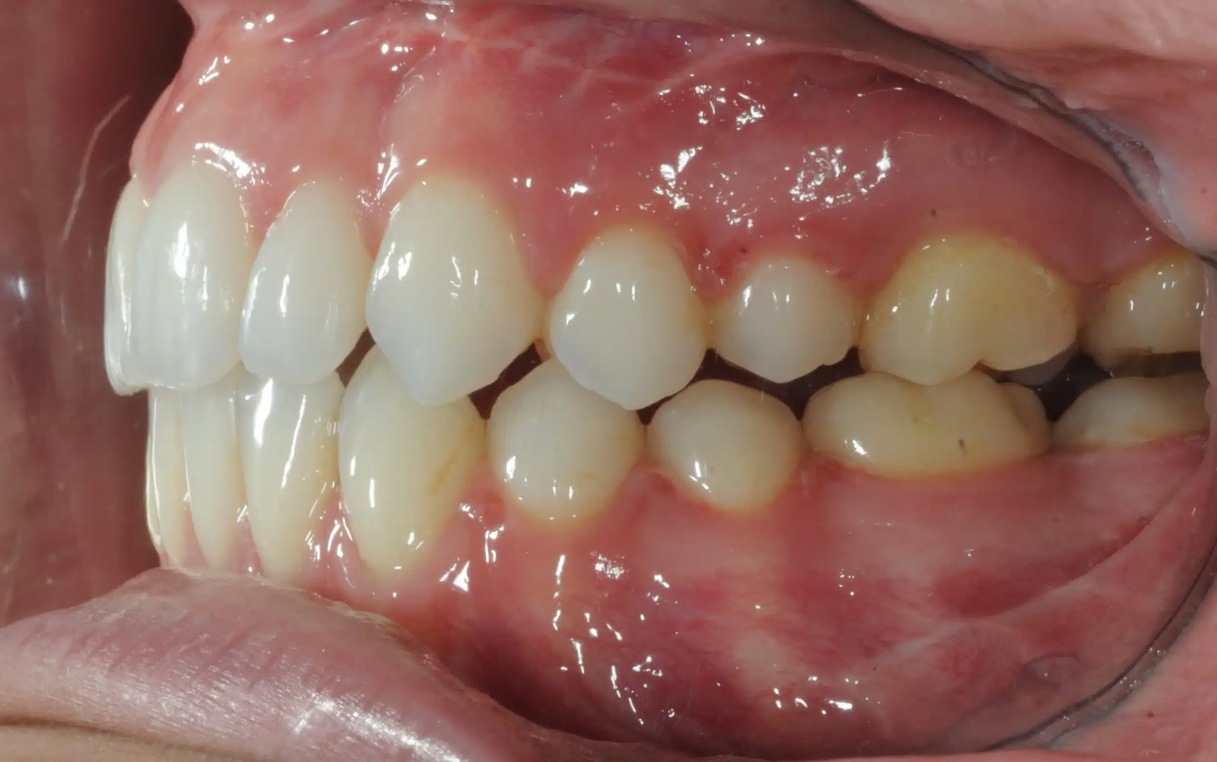 130950- DEBOND 1-12-2025 1ST SET OF BRACES - 130950 - Ines Castro - Deband 11 - Intraoral Left.jpg