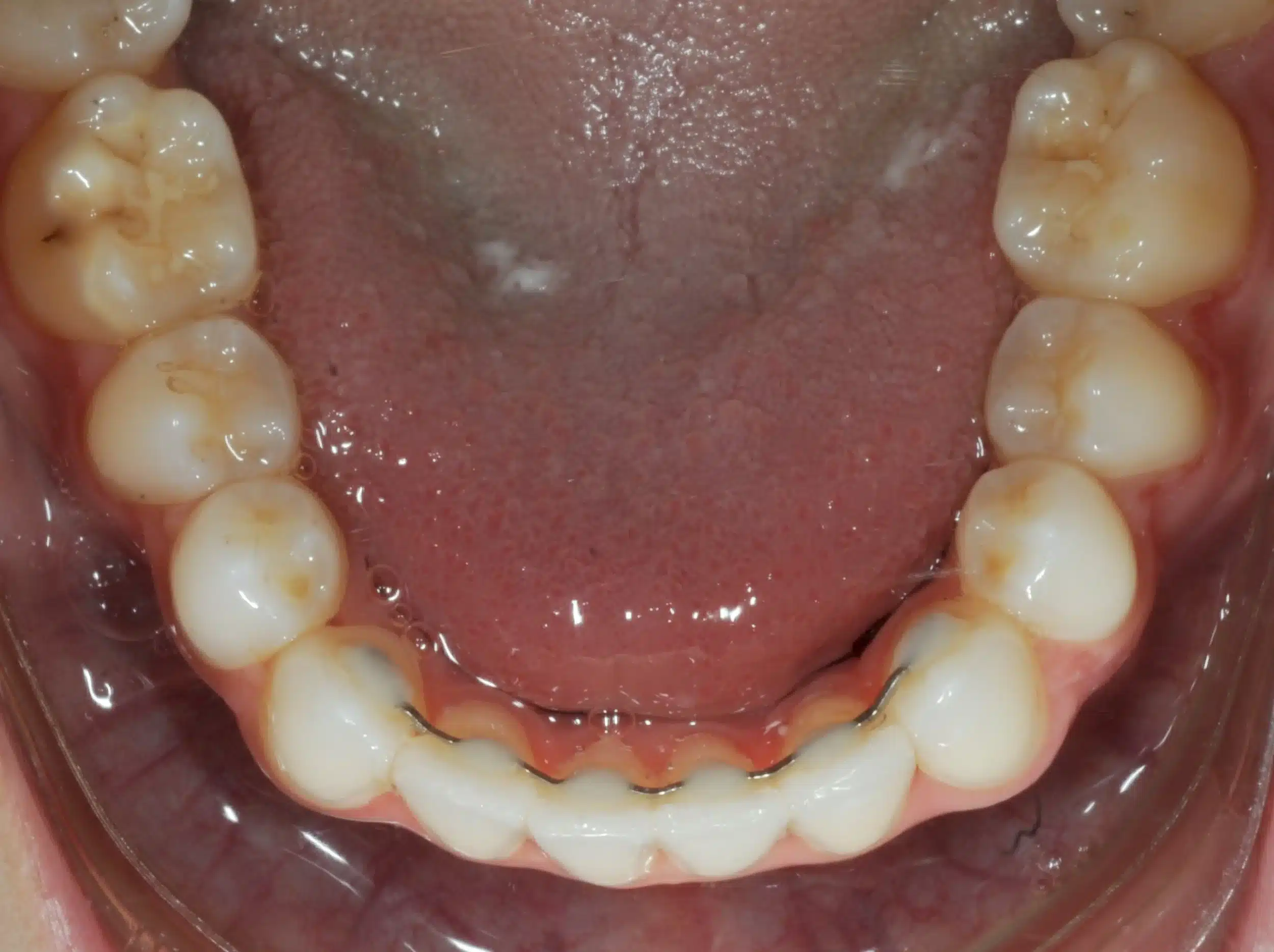 130950- DEBOND 1-12-2025 1ST SET OF BRACES - 130950 - Ines Castro - Deband 11 - Occlusal Lower.jpg