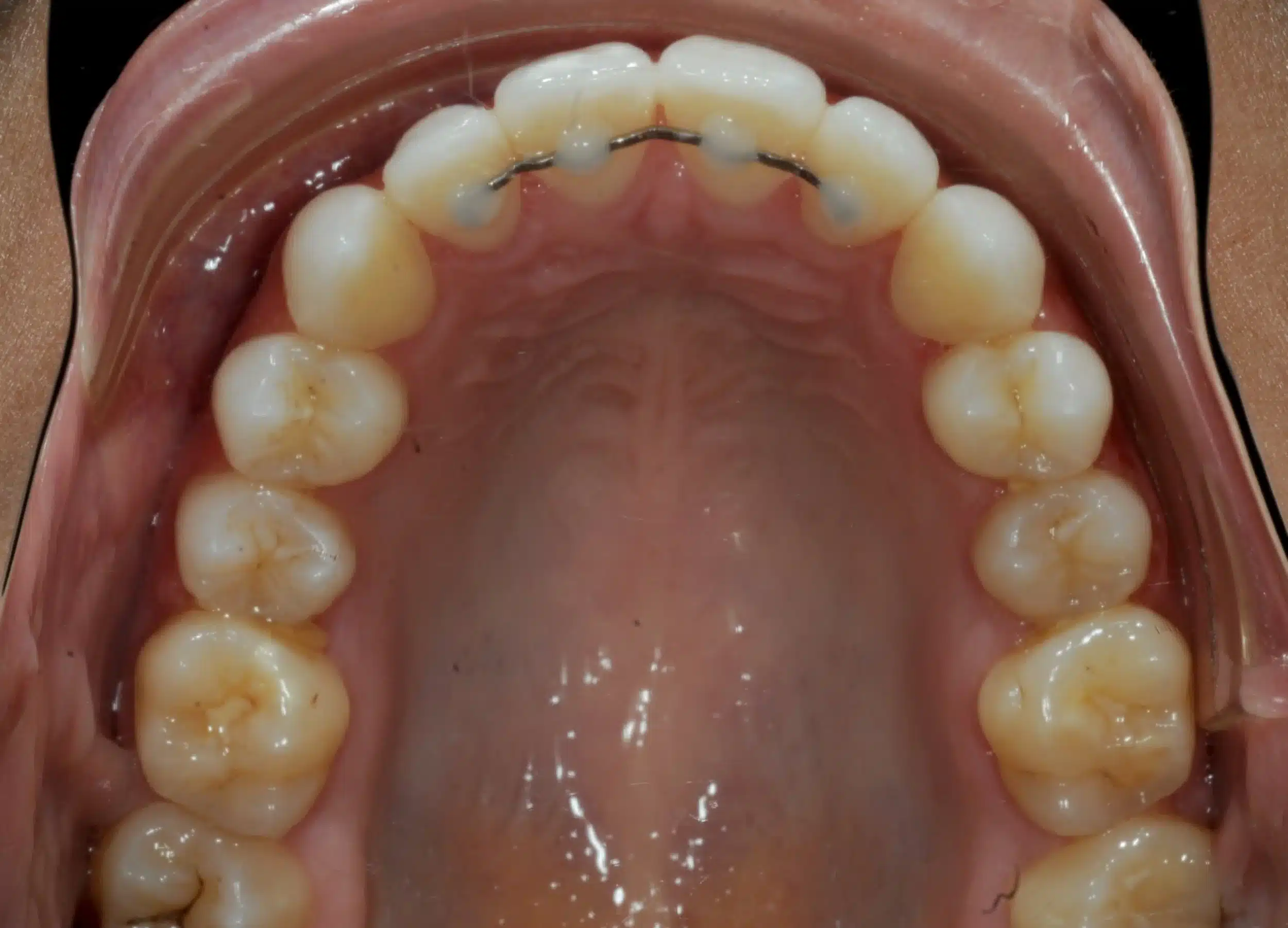 130950- DEBOND 1-12-2025 1ST SET OF BRACES - 130950 - Ines Castro - Deband 11 - Occlusal Upper.jpg