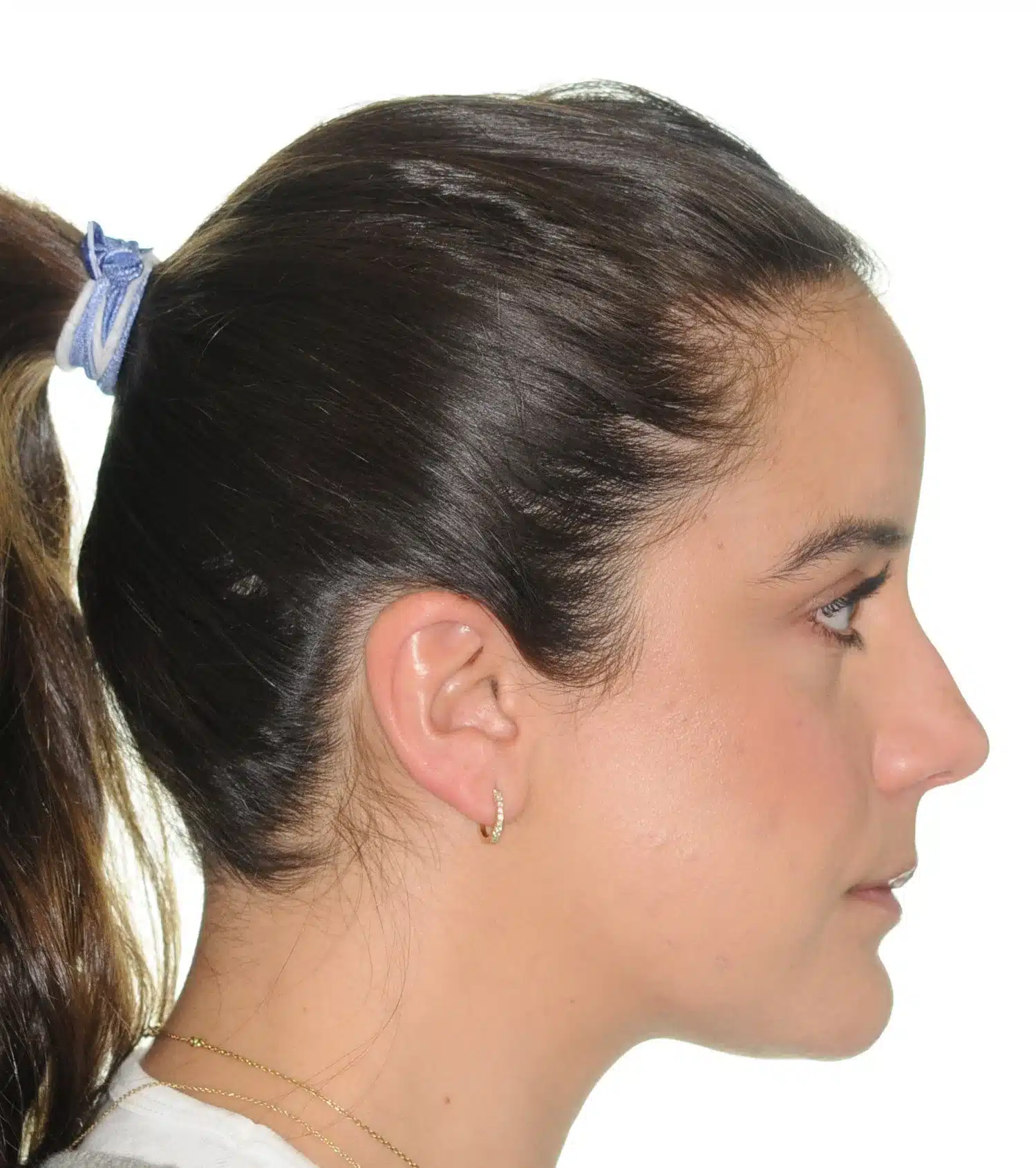 130950- Final 3-19-2024 - 130950 - Ines Castro - Invisalign 31_31 - Facial Profile.jpg