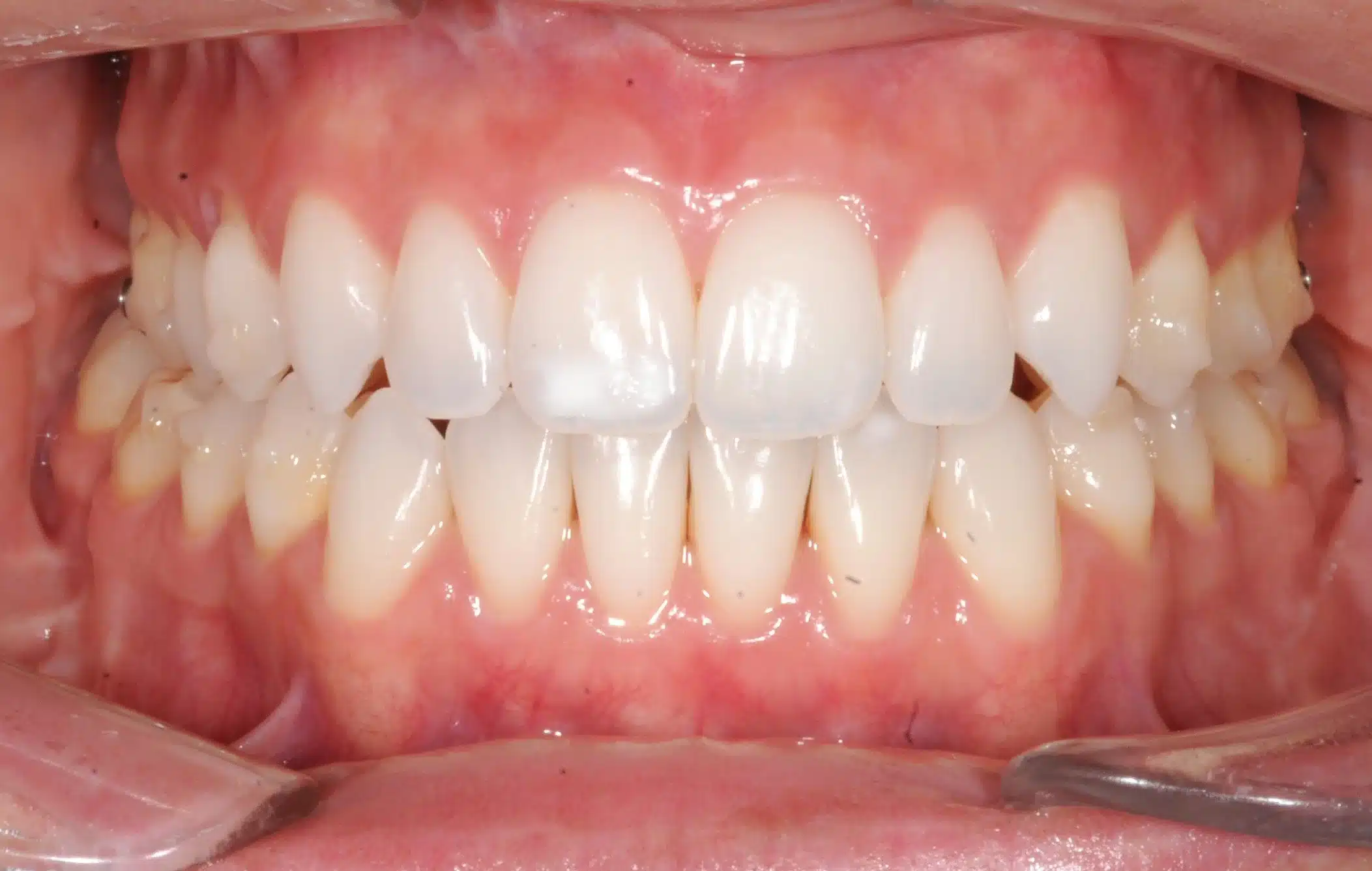 130950- Final 3-19-2024 - 130950 - Ines Castro - Invisalign 31_31 - Intraoral Center.jpg