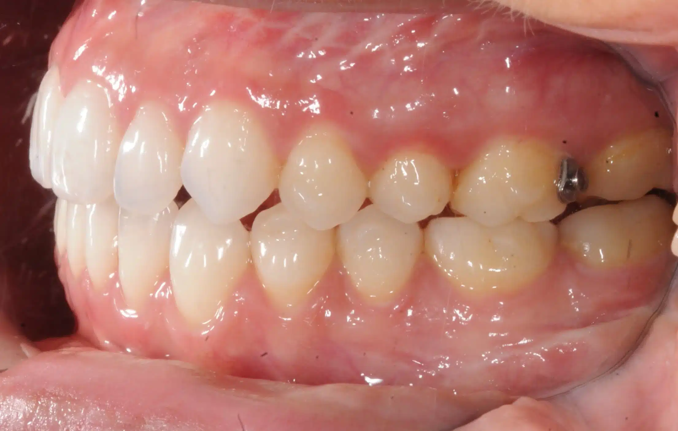 130950- Final 3-19-2024 - 130950 - Ines Castro - Invisalign 31_31 - Intraoral Left.jpg