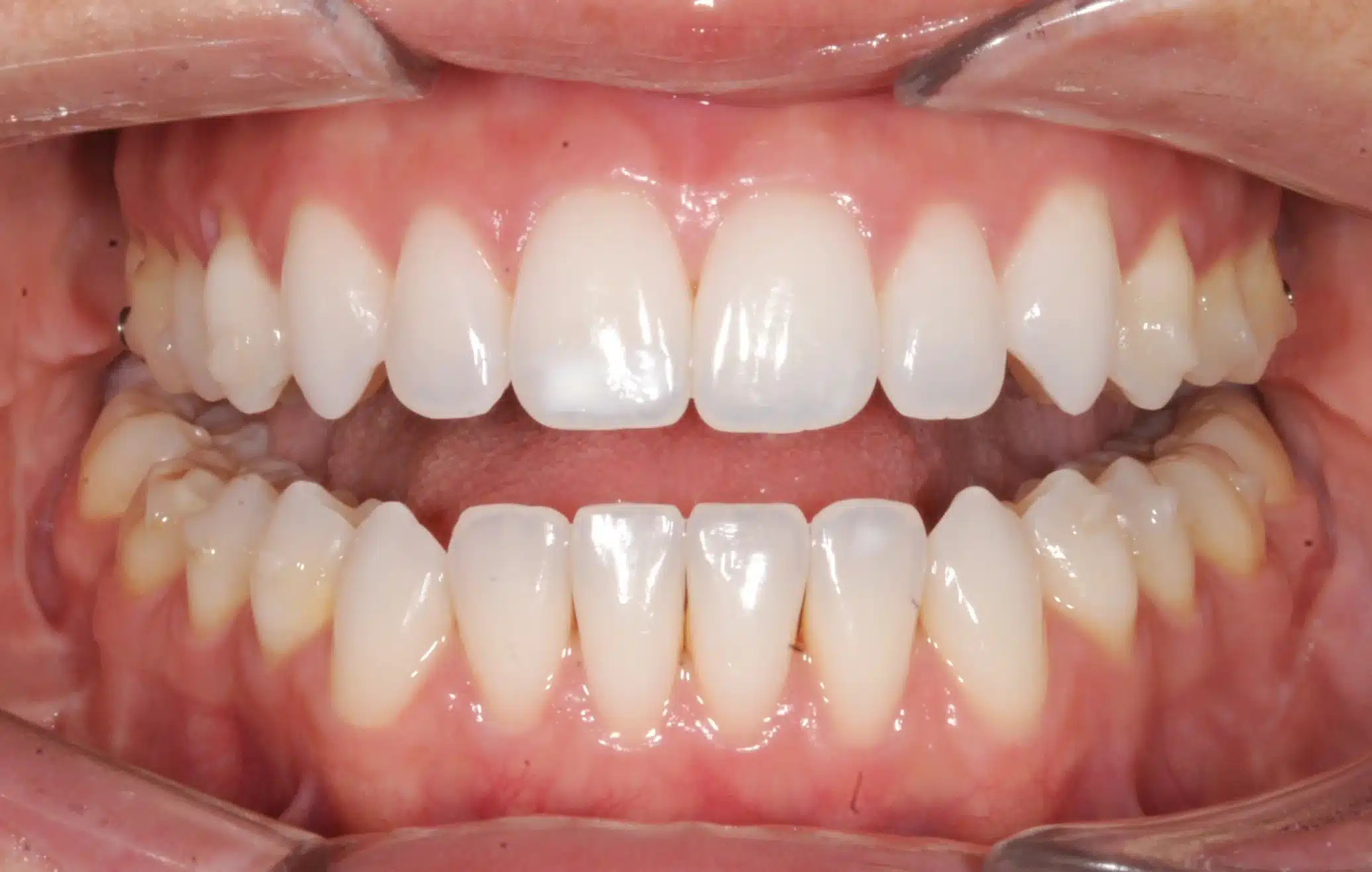 130950- Final 3-19-2024 - 130950 - Ines Castro - Invisalign 31_31 - Intraoral Misc.jpg