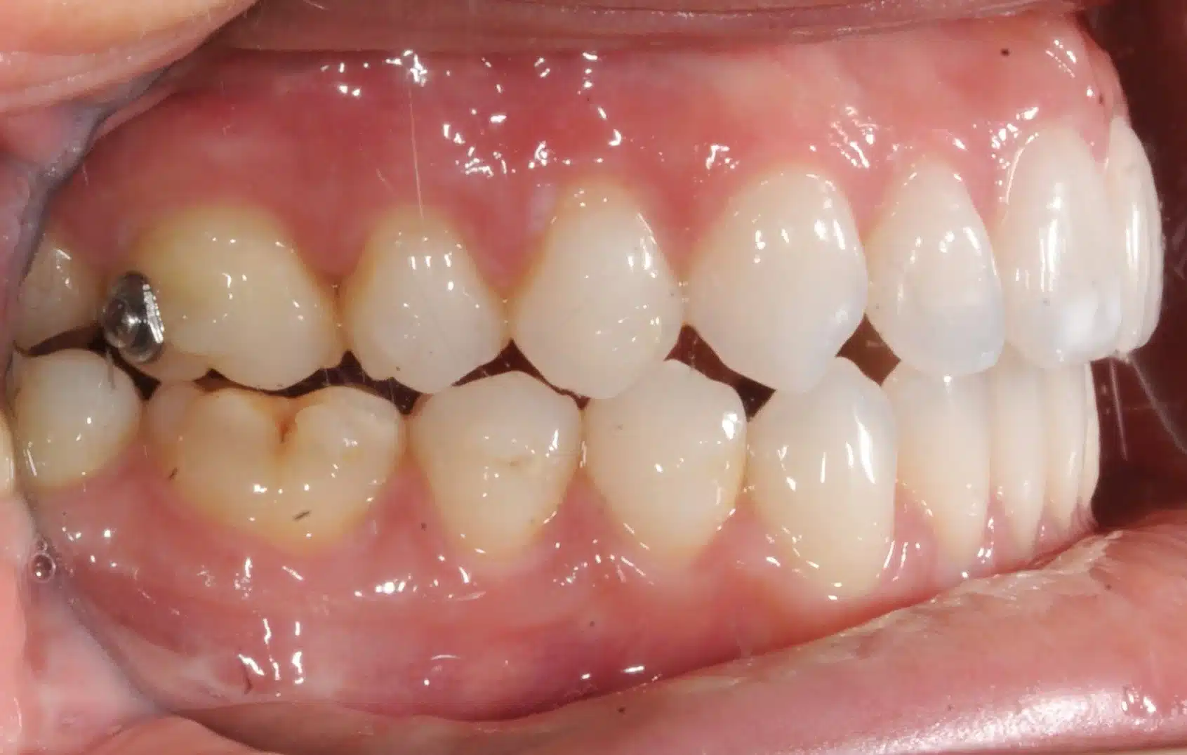 130950- Final 3-19-2024 - 130950 - Ines Castro - Invisalign 31_31 - Intraoral Right.jpg