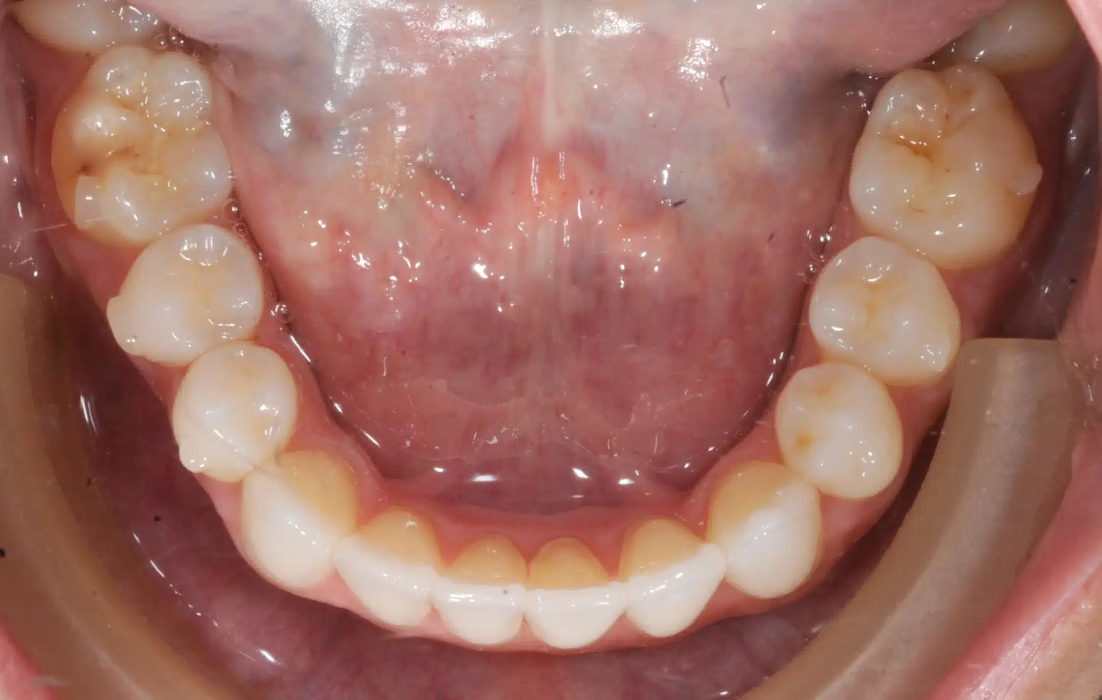 130950- Final 3-19-2024 - 130950 - Ines Castro - Invisalign 31_31 - Occlusal Lower.jpg