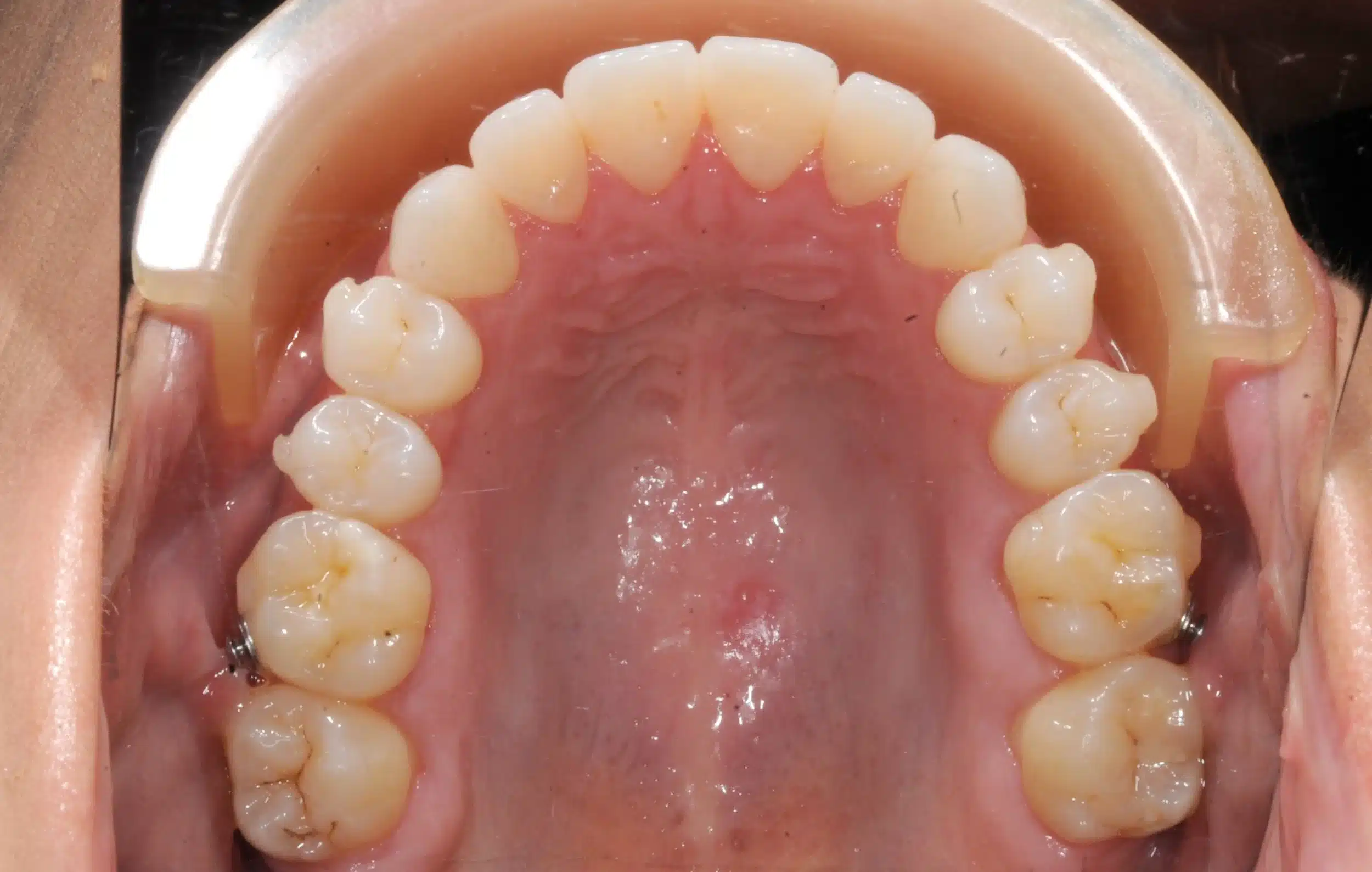 130950- Final 3-19-2024 - 130950 - Ines Castro - Invisalign 31_31 - Occlusal Upper.jpg