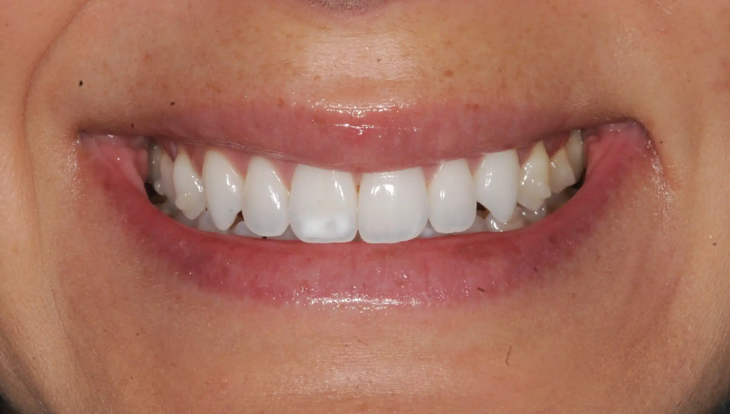 130950- Final 3-19-2024 - 130950 - Ines Castro - Invisalign 31_31 - X-ray Periapical Set L.jpg