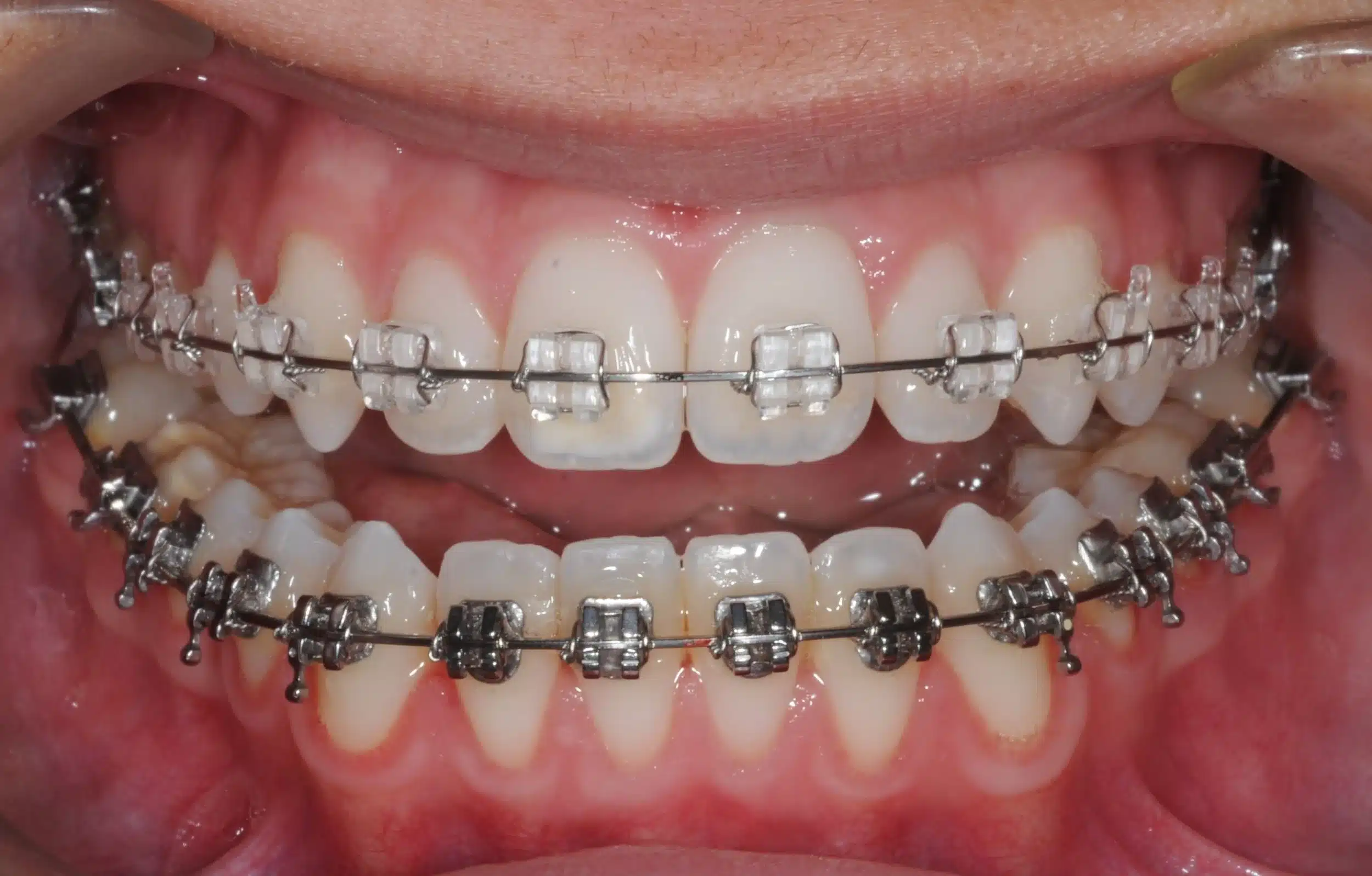 130950 - Ines Castro - progress 11 - Intraoral Center.jpg