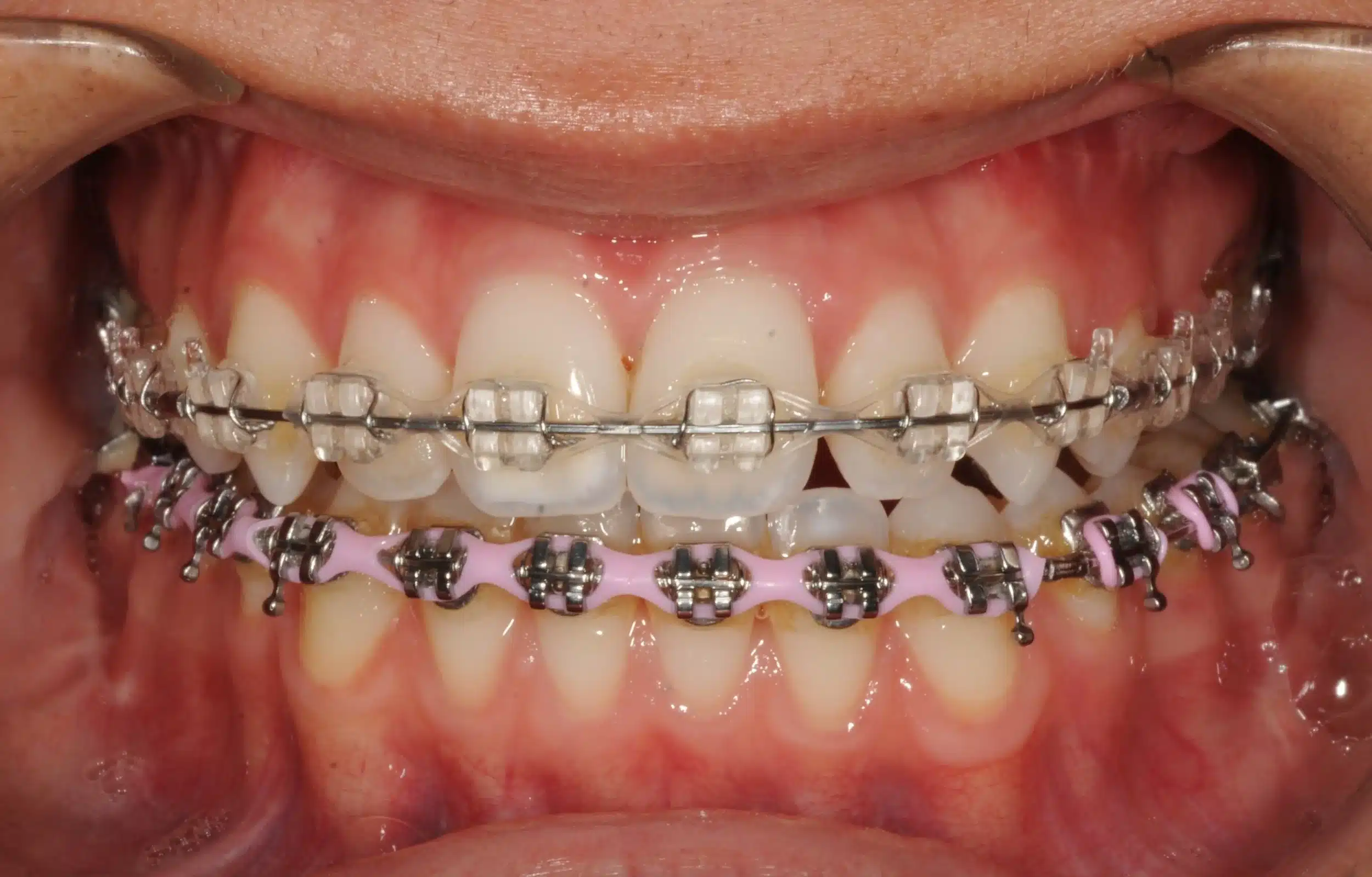 130950 - Ines Castro - progress 11 - Intraoral Center.jpg