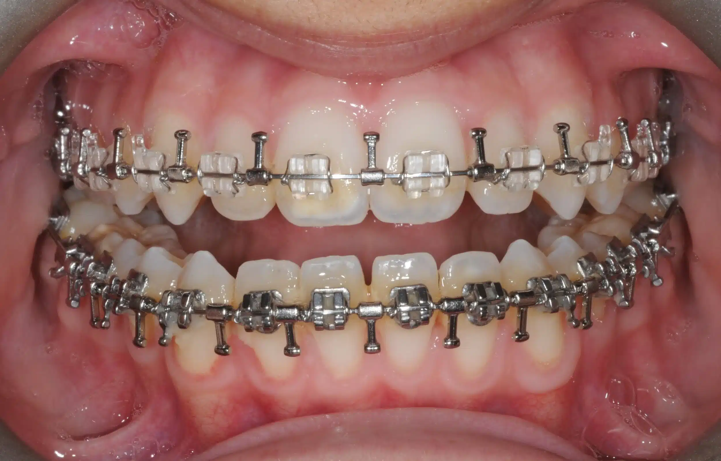 130950 - Ines Castro - progress 11 - Intraoral Center.jpg
