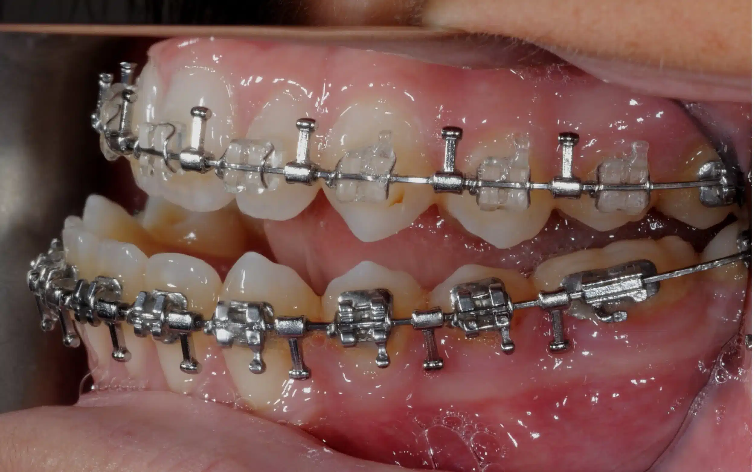 130950 - Ines Castro - progress 11 - Intraoral Left.jpg