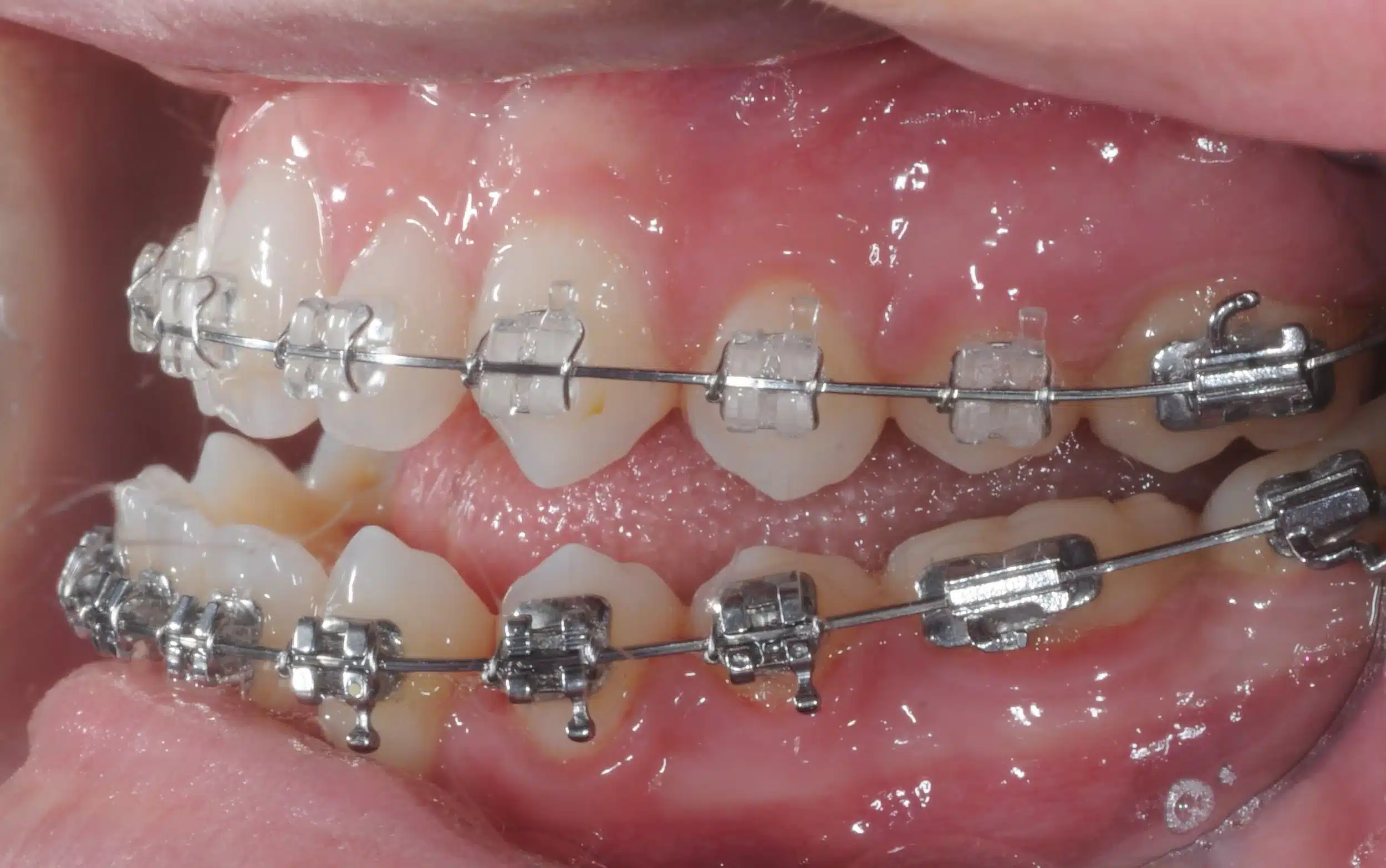 130950 - Ines Castro - progress 11 - Intraoral Left.jpg