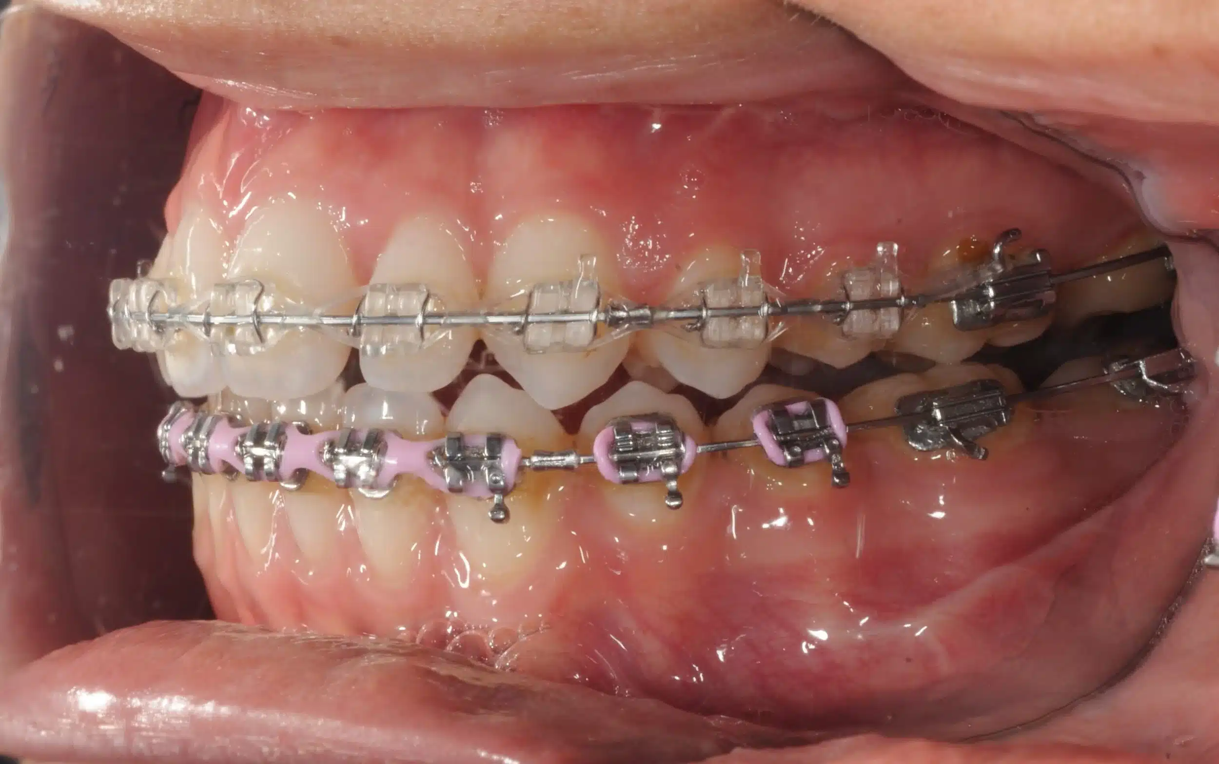 130950 - Ines Castro - progress 11 - Intraoral Left.jpg