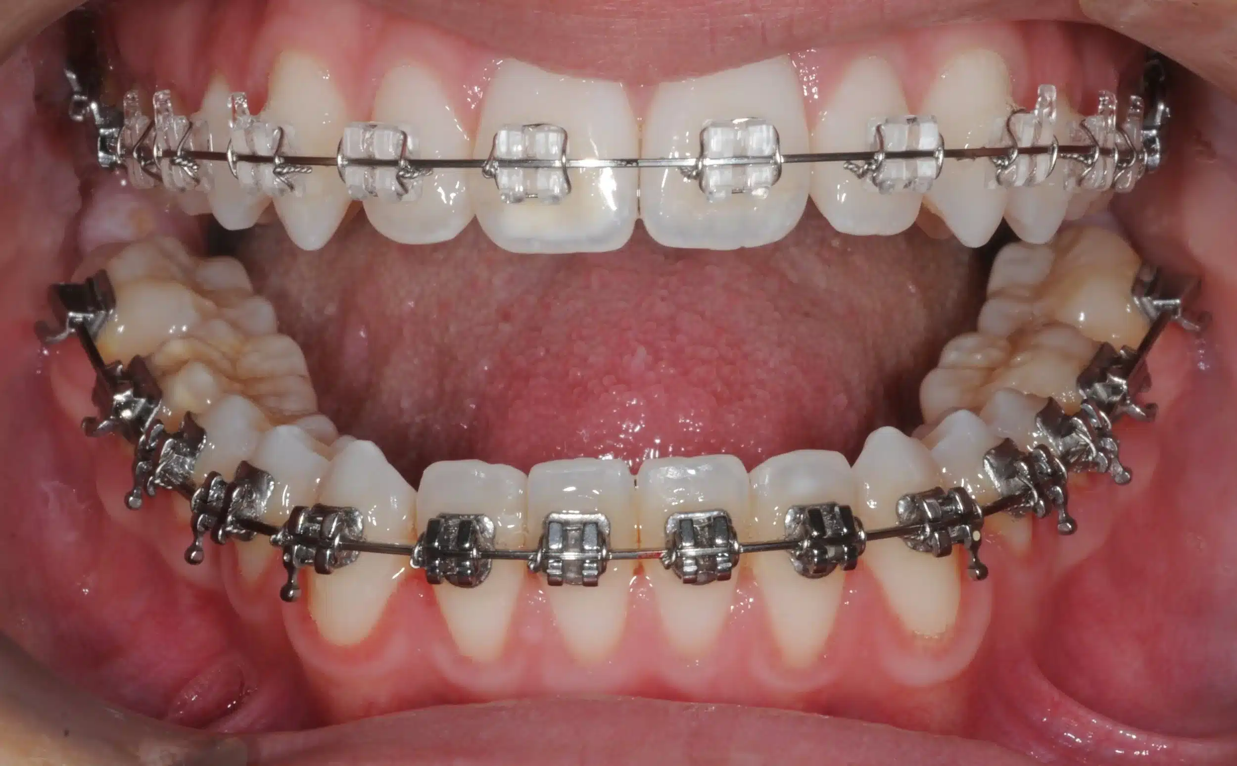130950 - Ines Castro - progress 11 - Intraoral Misc.jpg