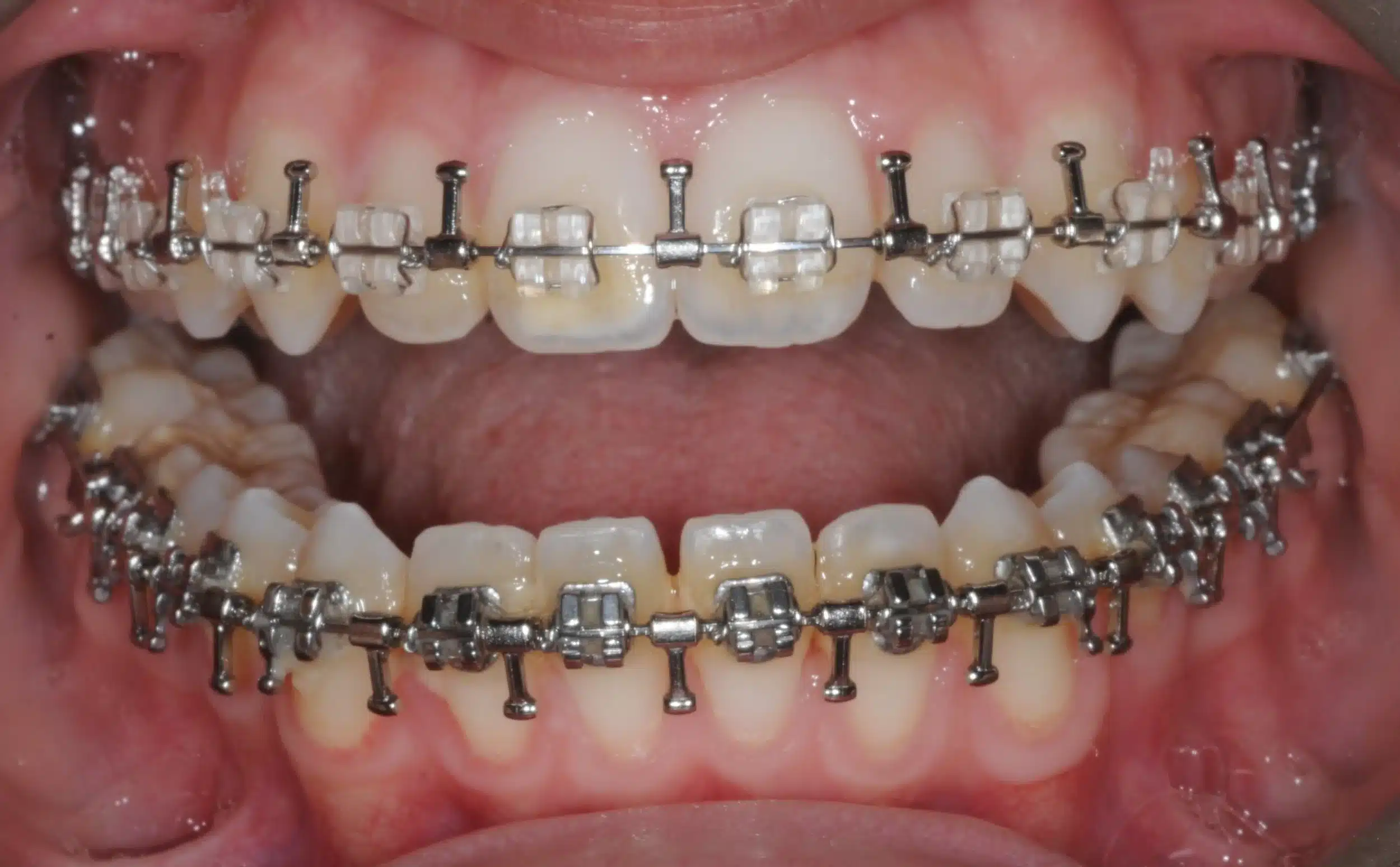 130950 - Ines Castro - progress 11 - Intraoral Misc.jpg