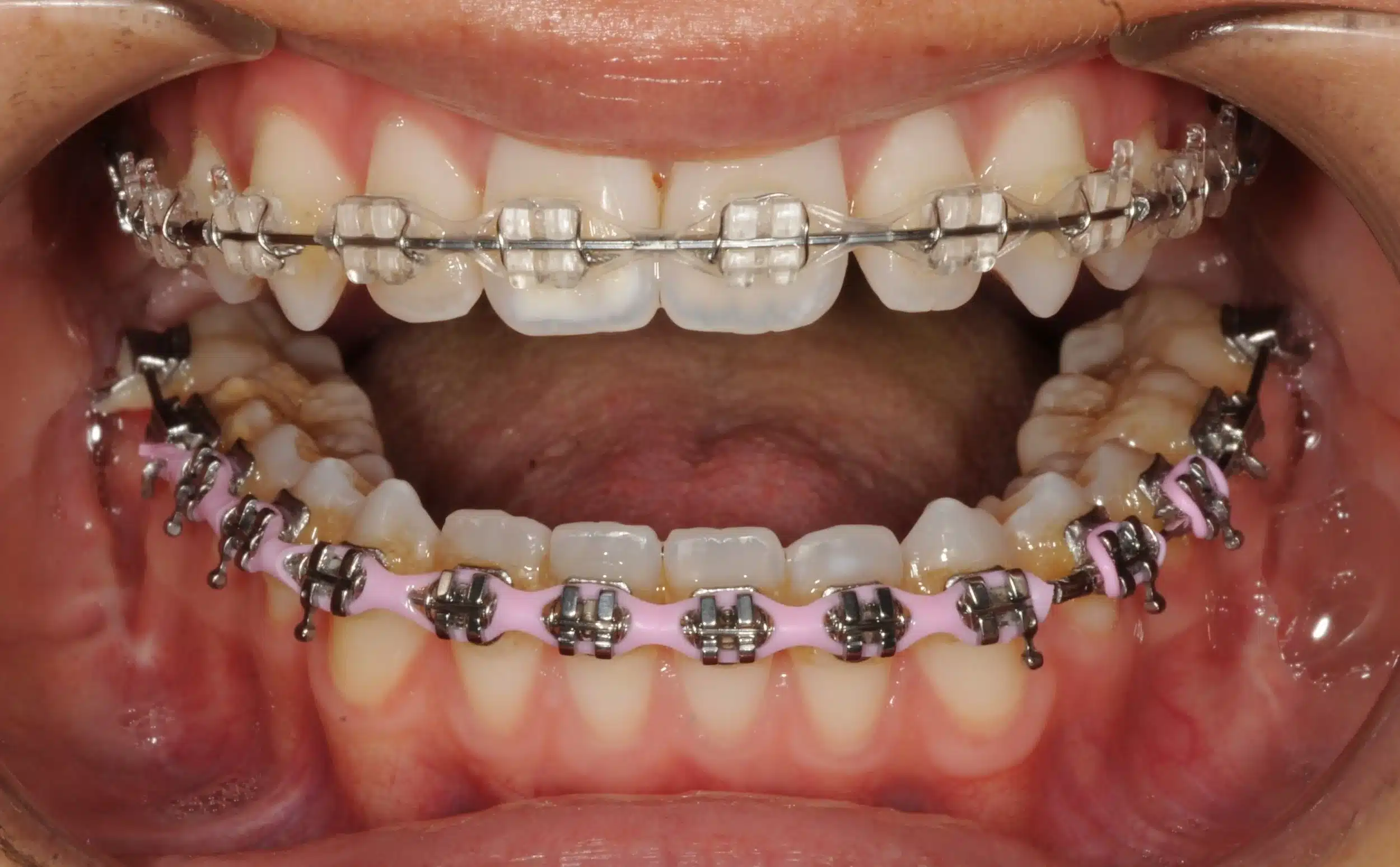 130950 - Ines Castro - progress 11 - Intraoral Misc.jpg