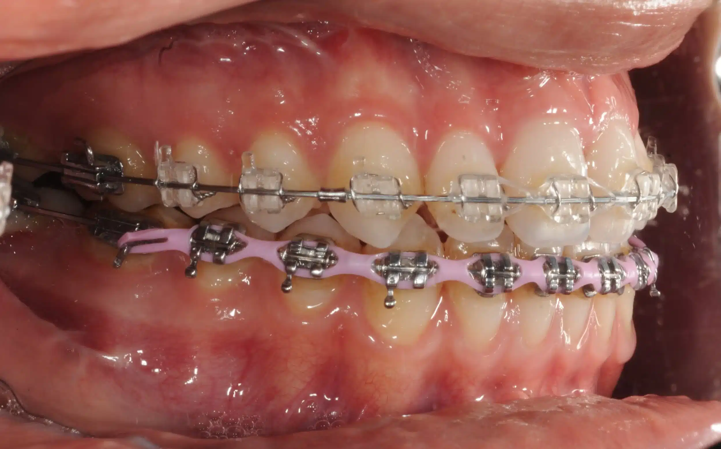 130950 - Ines Castro - progress 11 - Intraoral Right.jpg