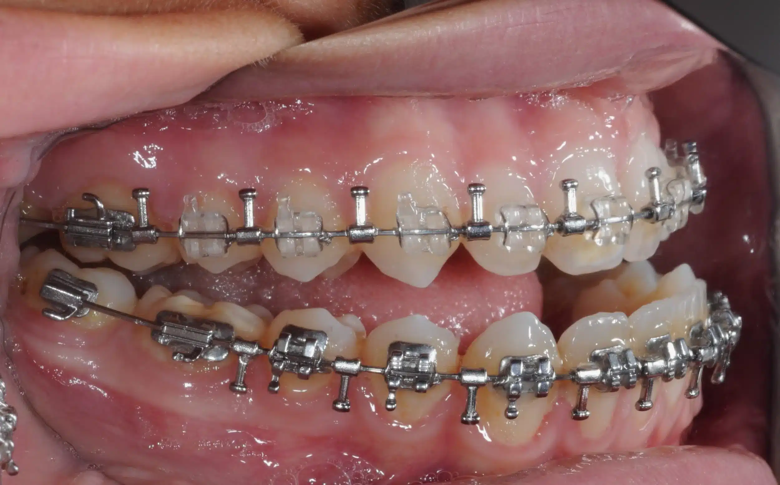 130950 - Ines Castro - progress 11 - Intraoral Right.jpg