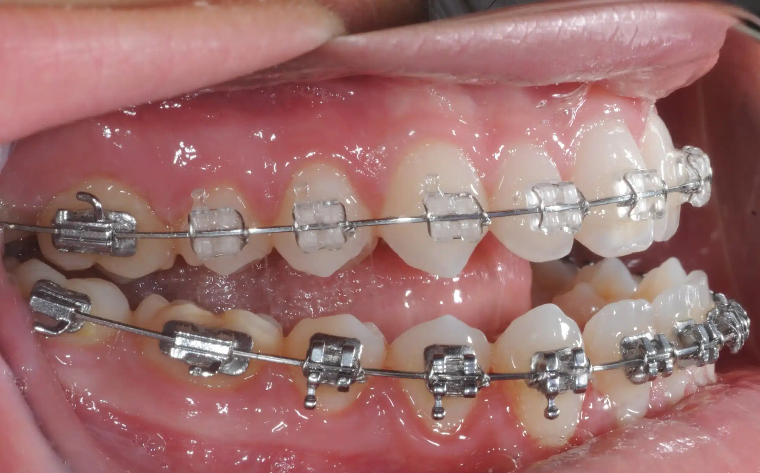130950 - Ines Castro - progress 11 - Intraoral Right.jpg
