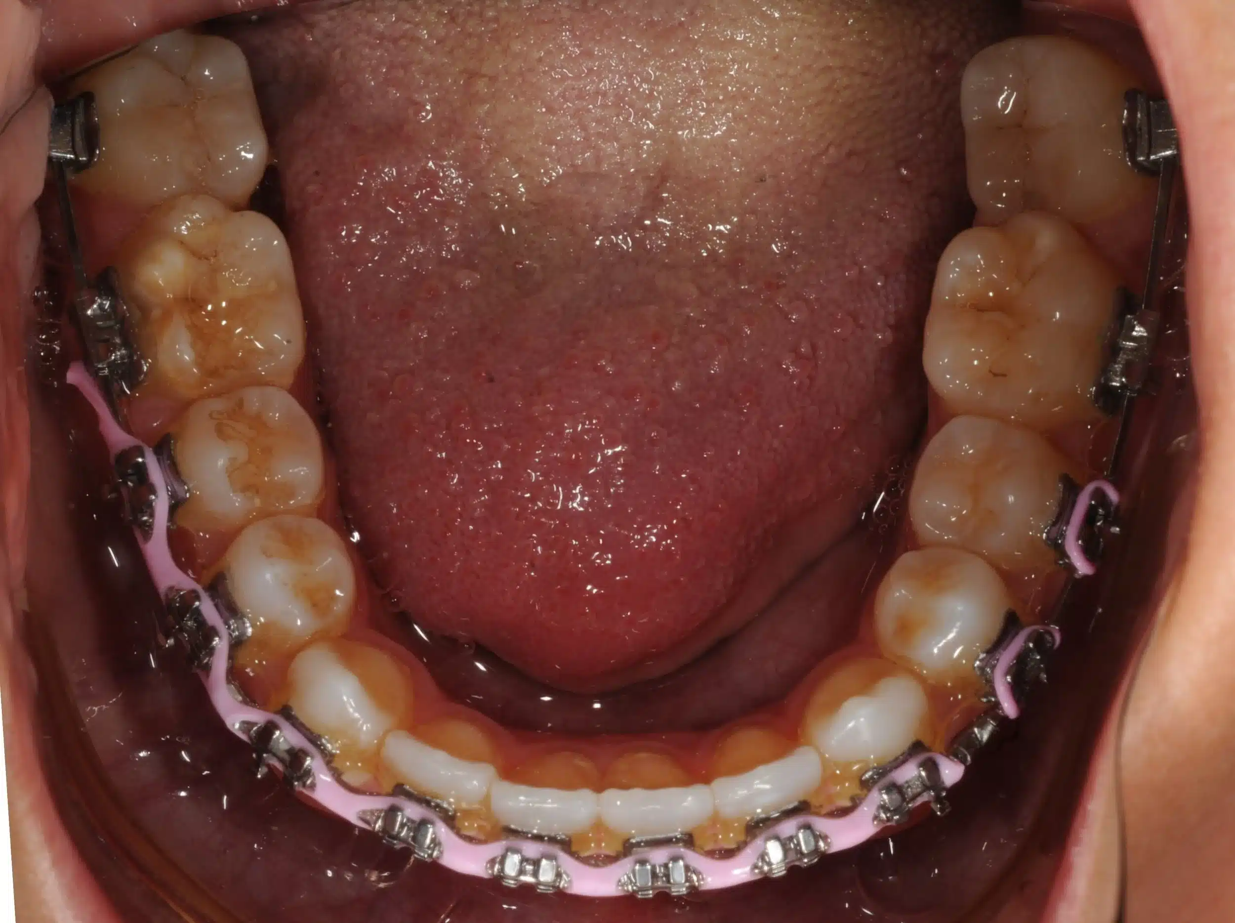 130950 - Ines Castro - progress 11 - Occlusal Lower.jpg