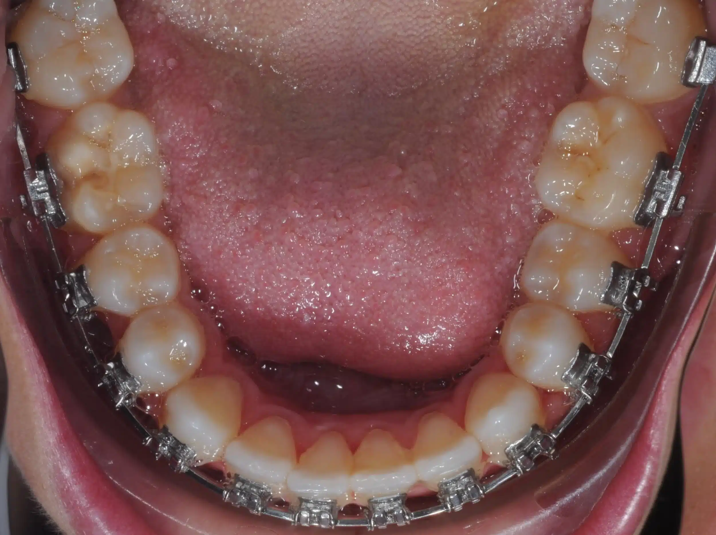 130950 - Ines Castro - progress 11 - Occlusal Lower.jpg