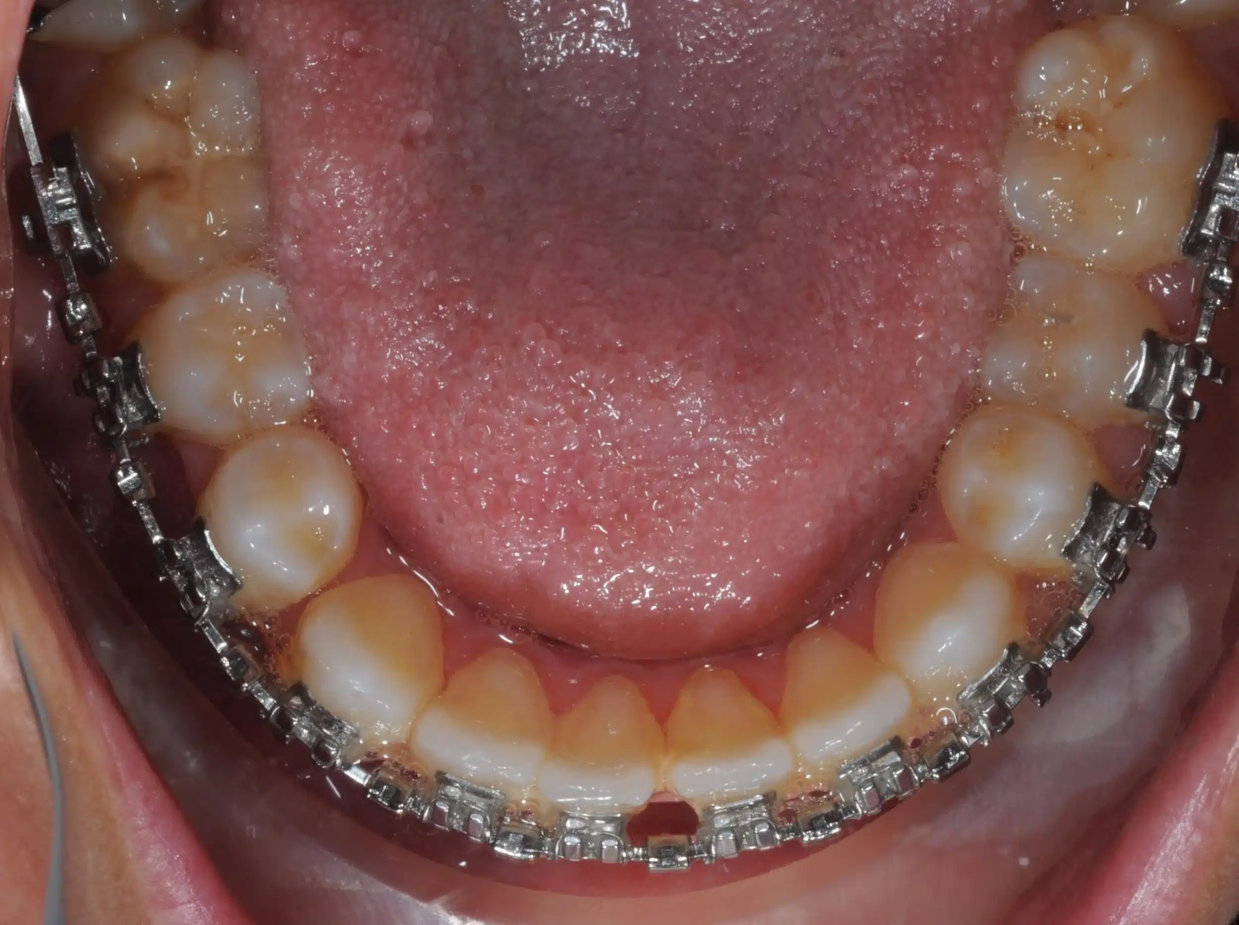 130950 - Ines Castro - progress 11 - Occlusal Lower.jpg