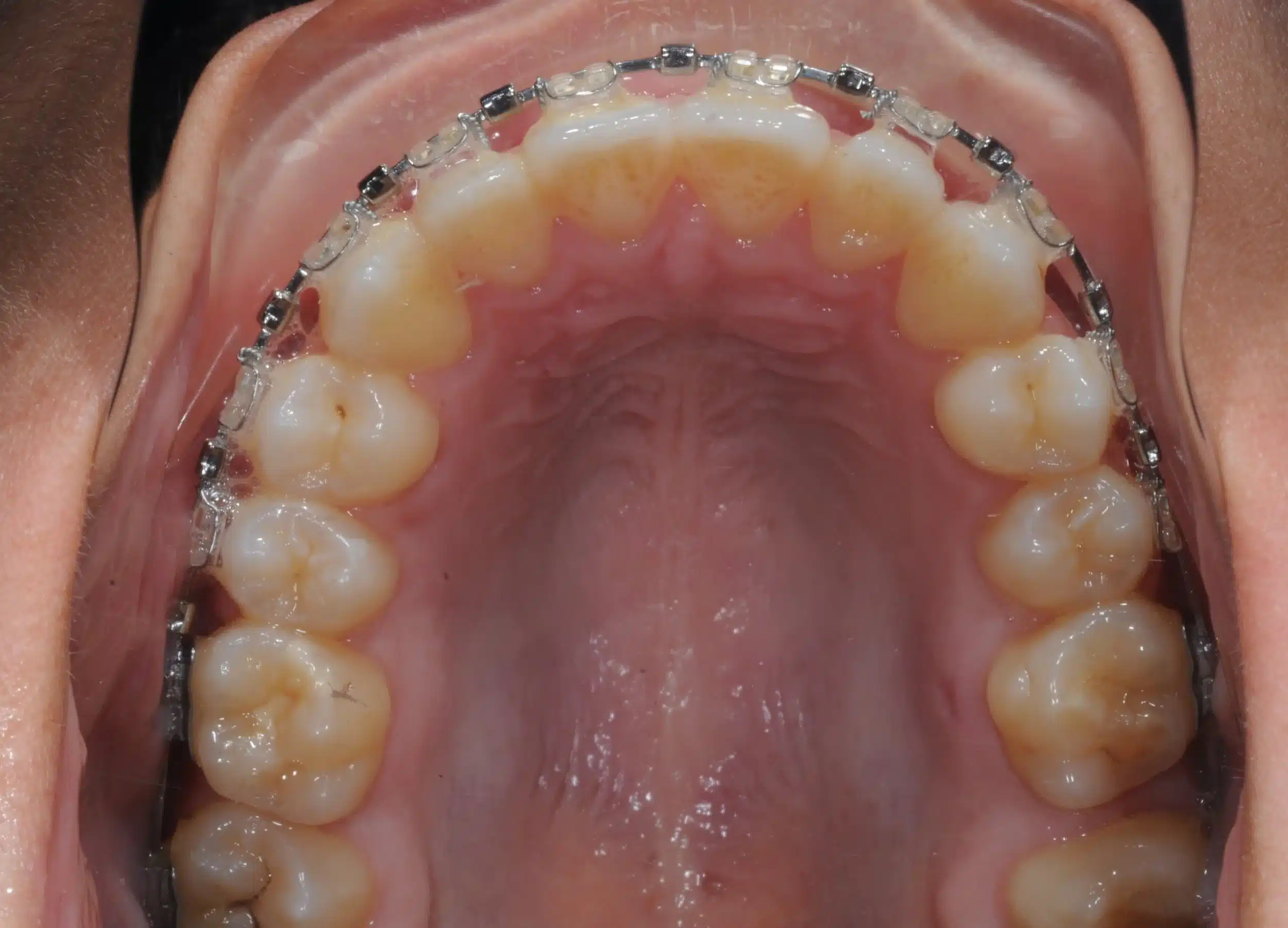 130950 - Ines Castro - progress 11 - Occlusal Upper.jpg