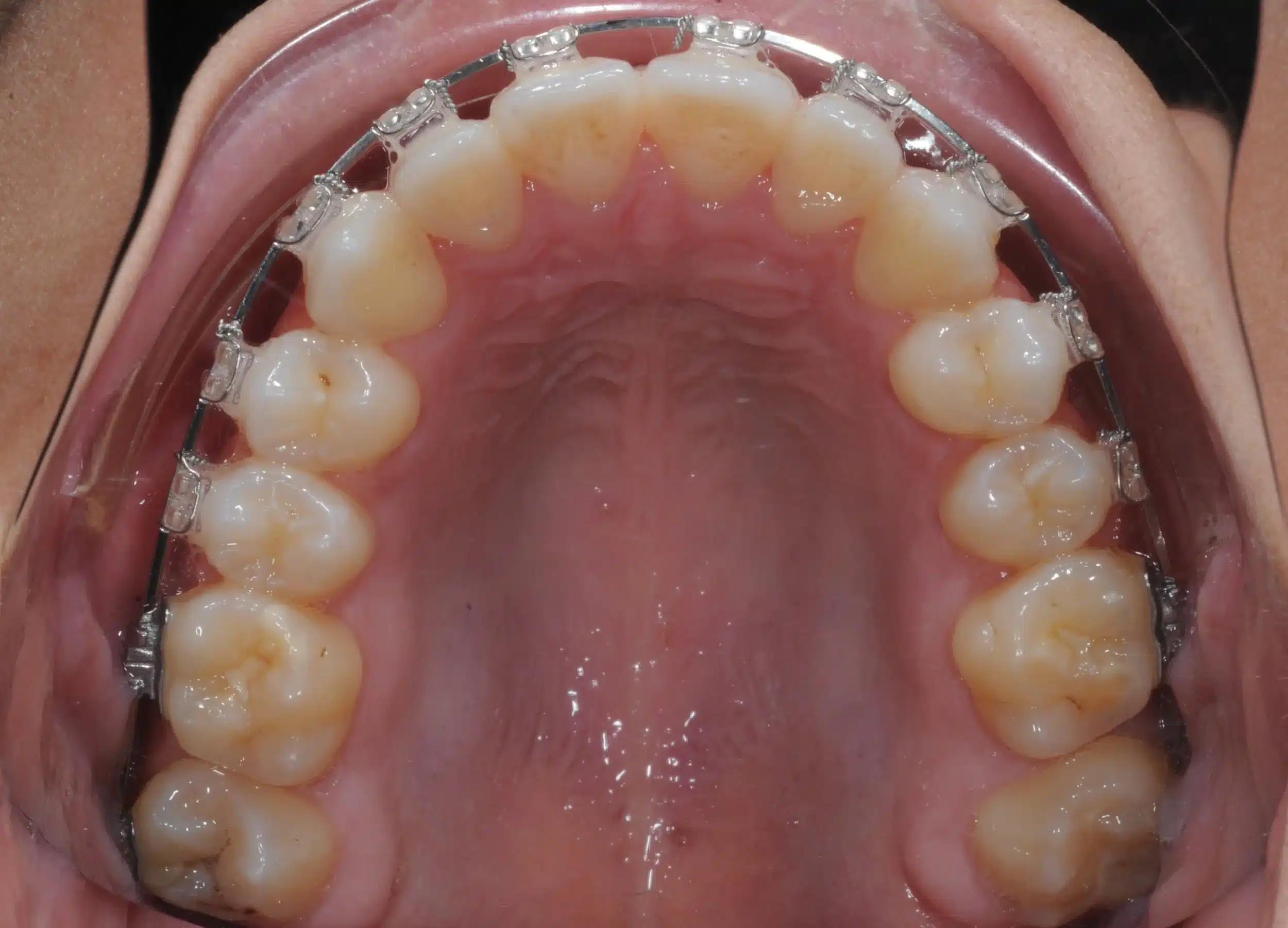 130950 - Ines Castro - progress 11 - Occlusal Upper.jpg