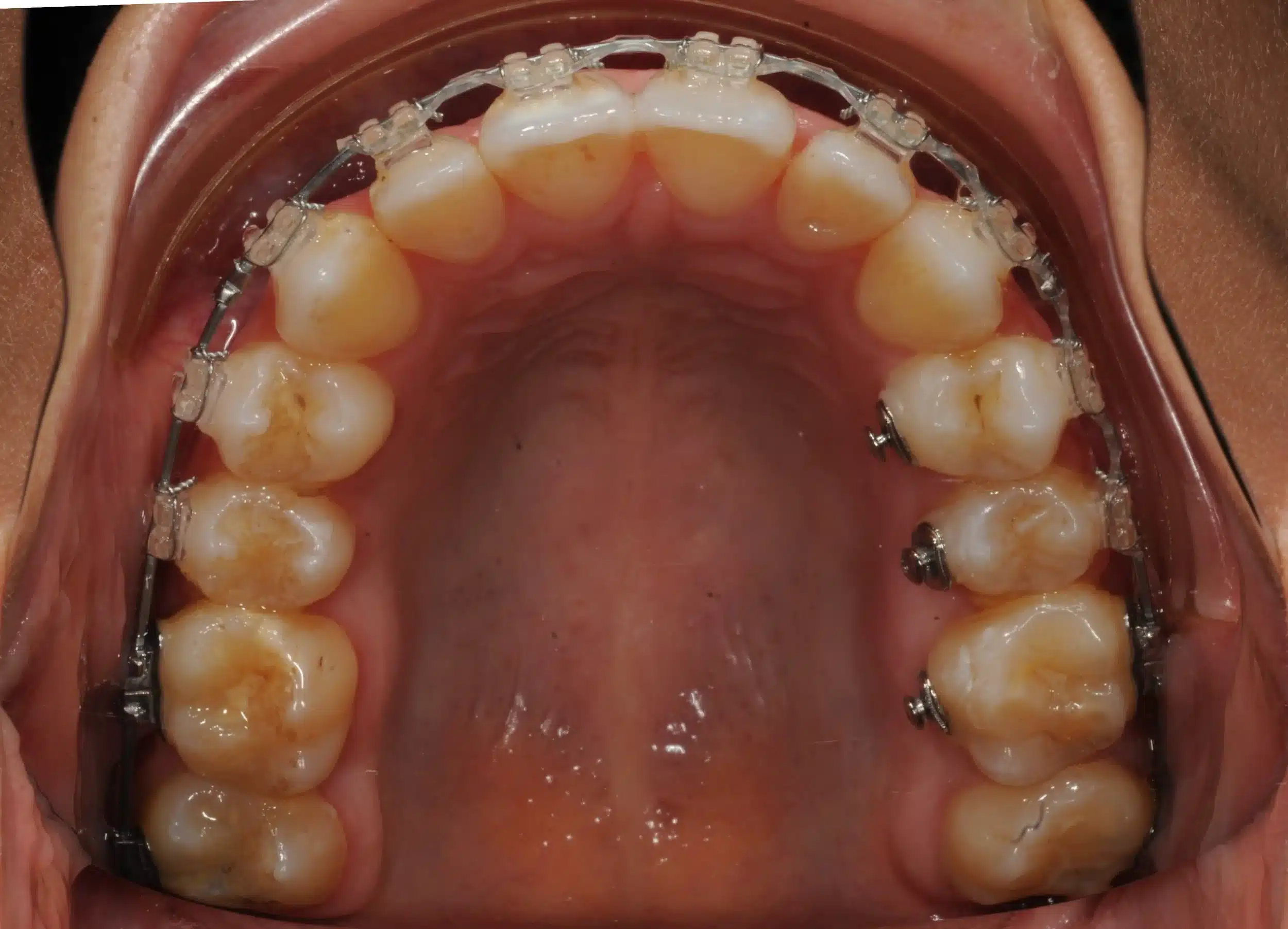130950 - Ines Castro - progress 11 - Occlusal Upper.jpg