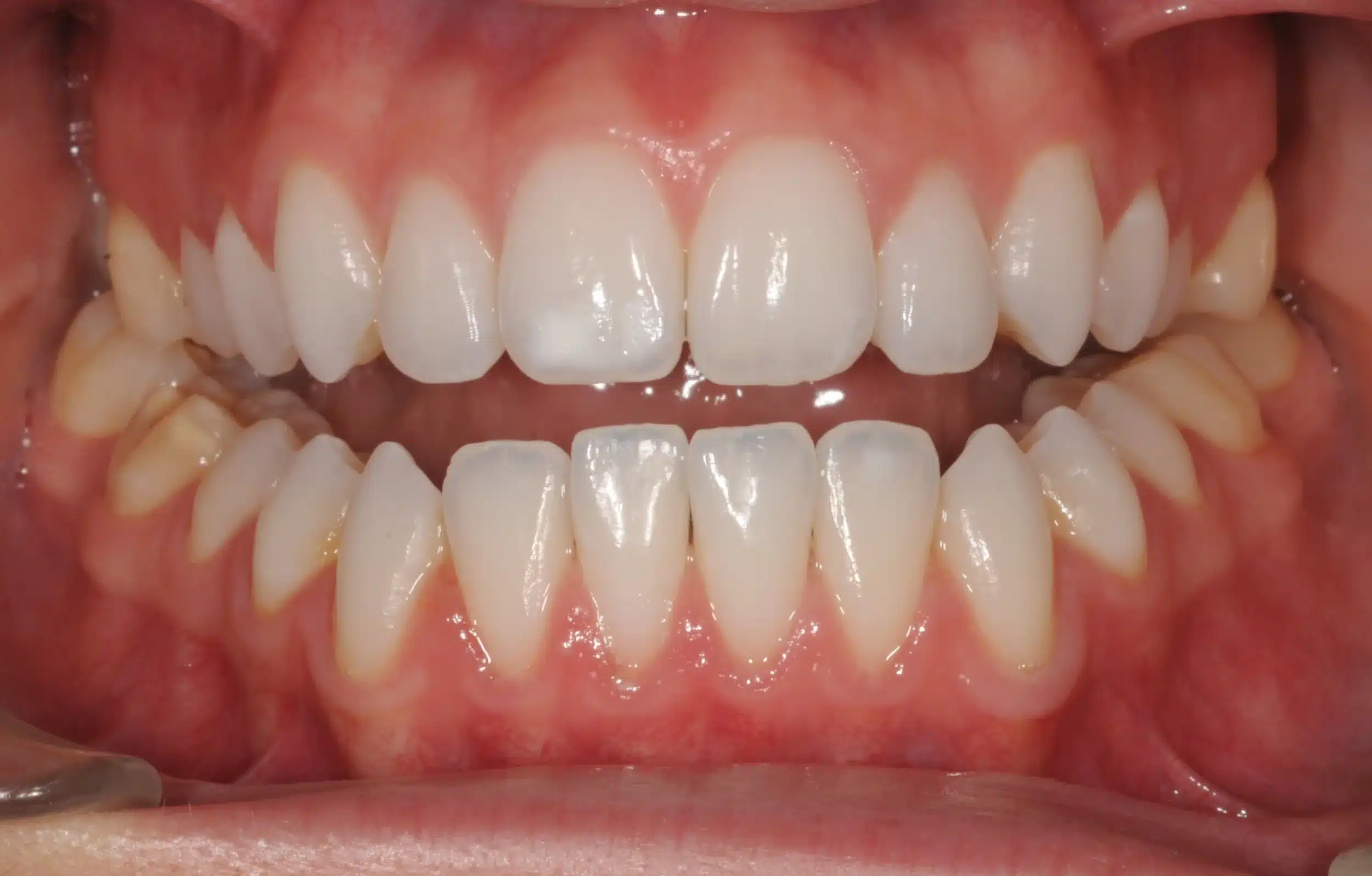 130950- INITIAL 11-23-13 - 130950 - Ines Castro - initial 11 - Intraoral Center.jpg