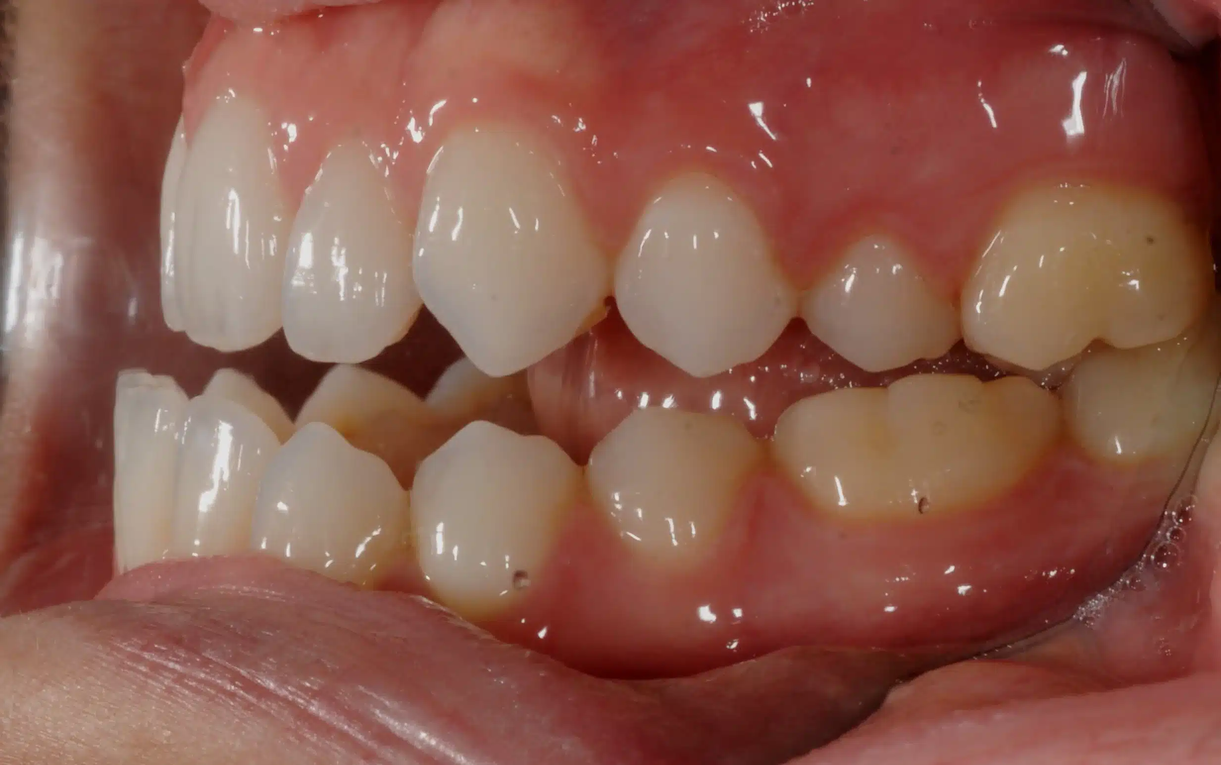 130950- INITIAL 11-23-13 - 130950 - Ines Castro - initial 11 - Intraoral Left.jpg