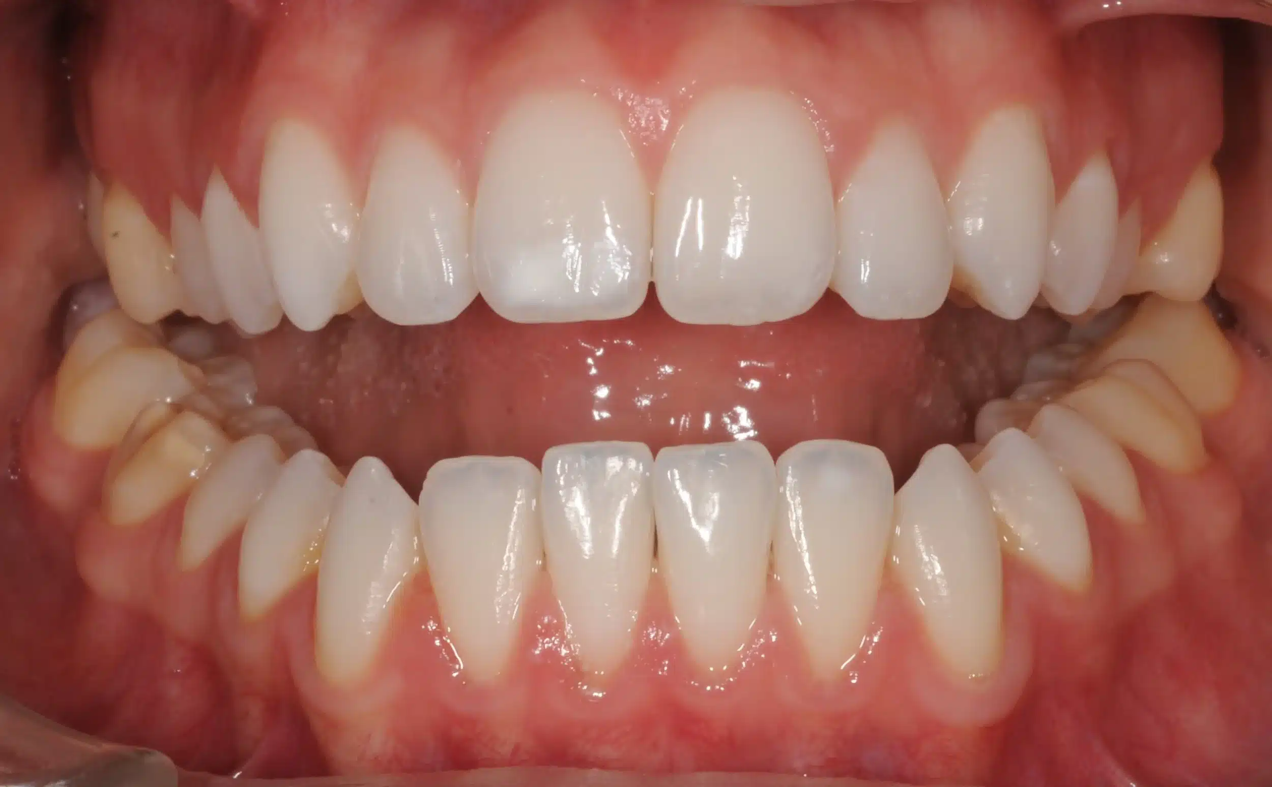 130950- INITIAL 11-23-13 - 130950 - Ines Castro - initial 11 - Intraoral Misc.jpg